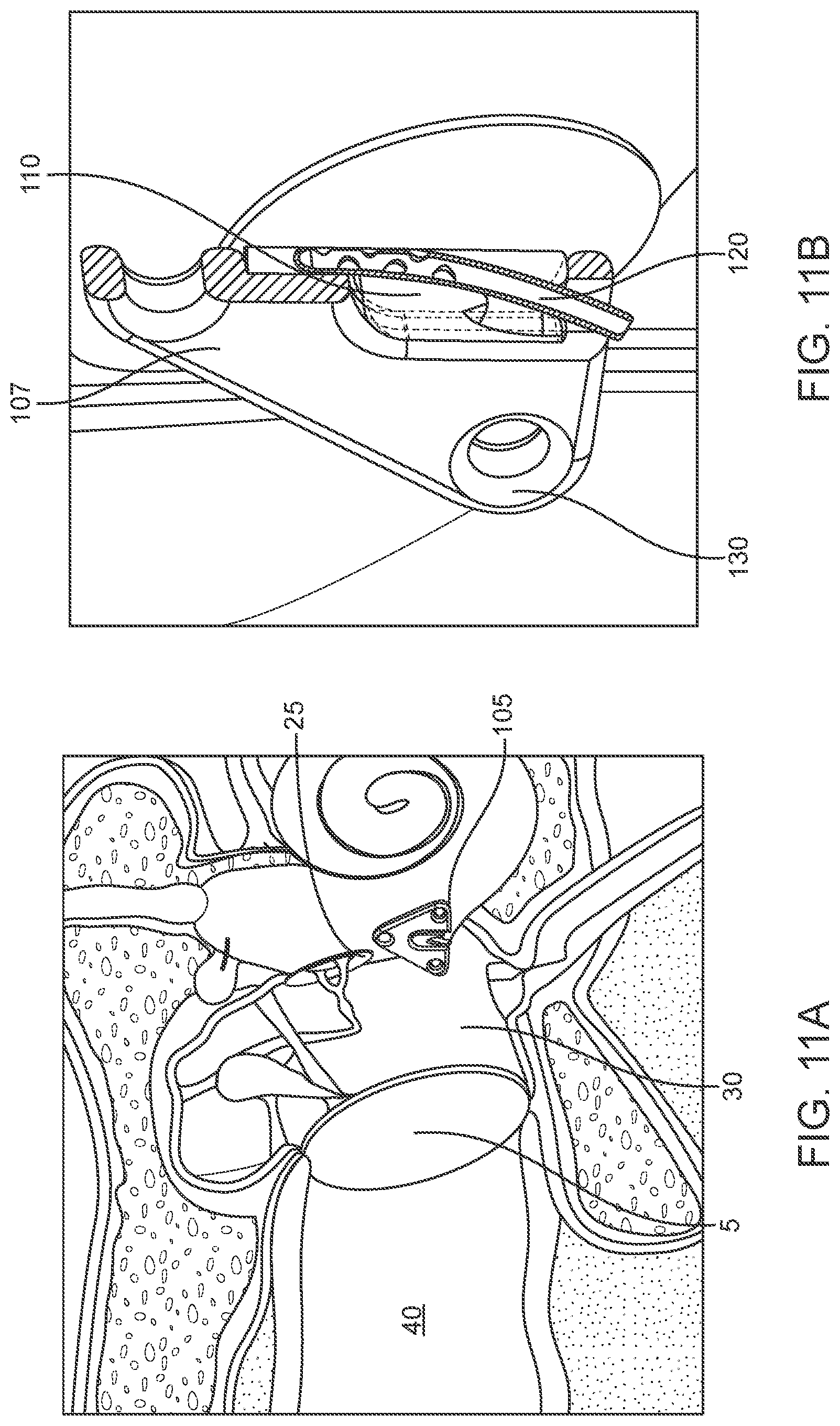 Patent US12102785 Figure 18 – Inner ear drug delivery devices and methods of use