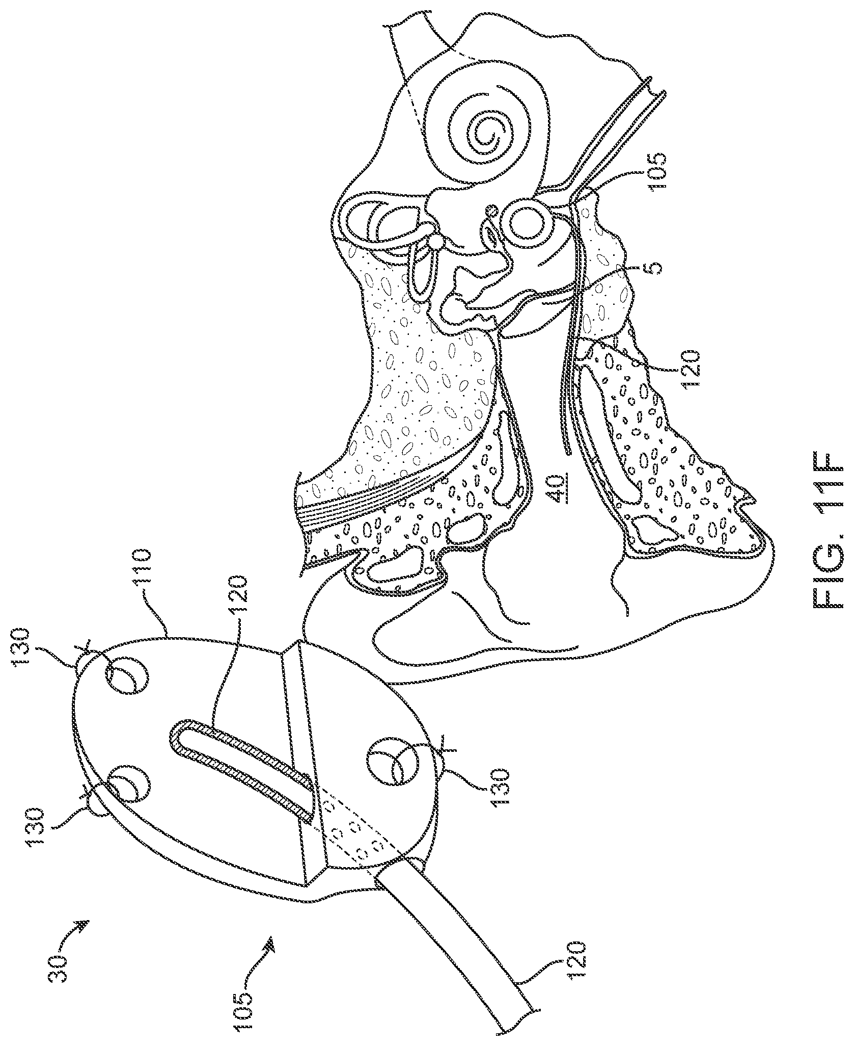 Patent US12102785 Figure 20 – Inner ear drug delivery devices and methods of use