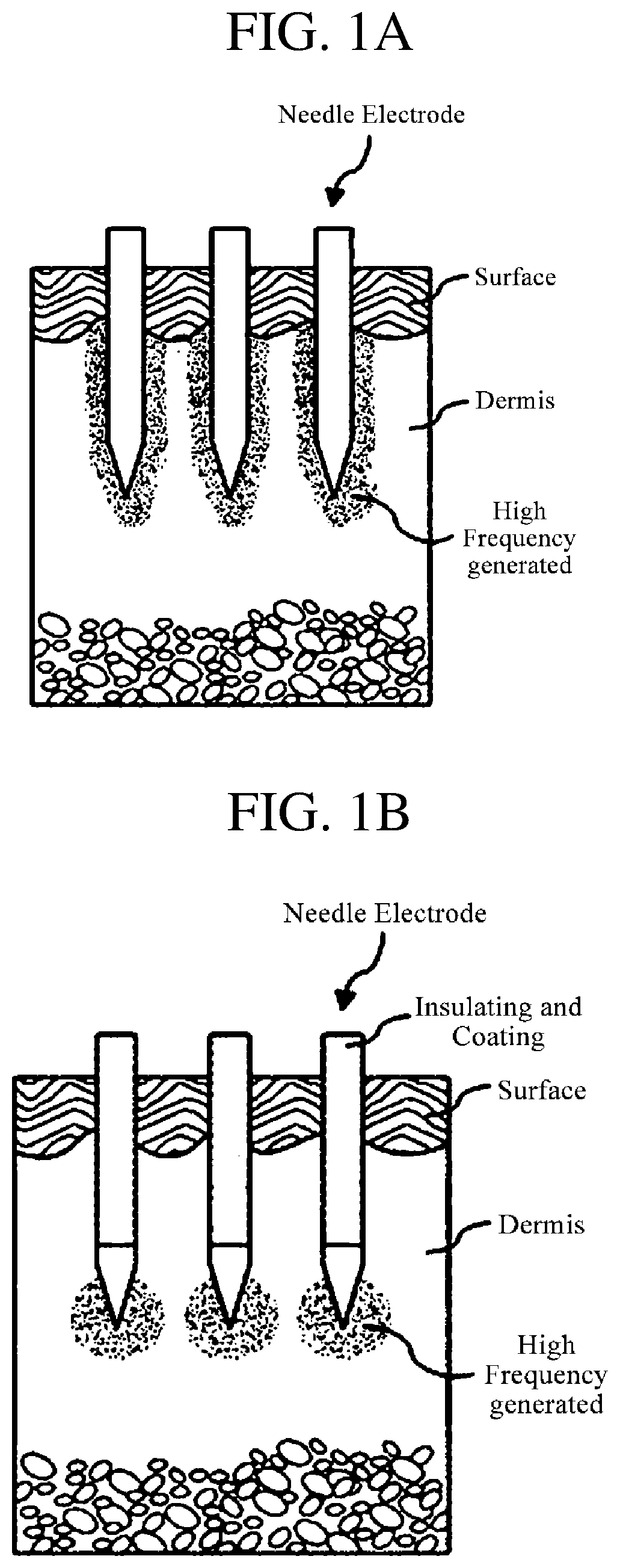 Patent US12102811 Figure 1 – Medicine injecting tip, hand piece, and skin treating device