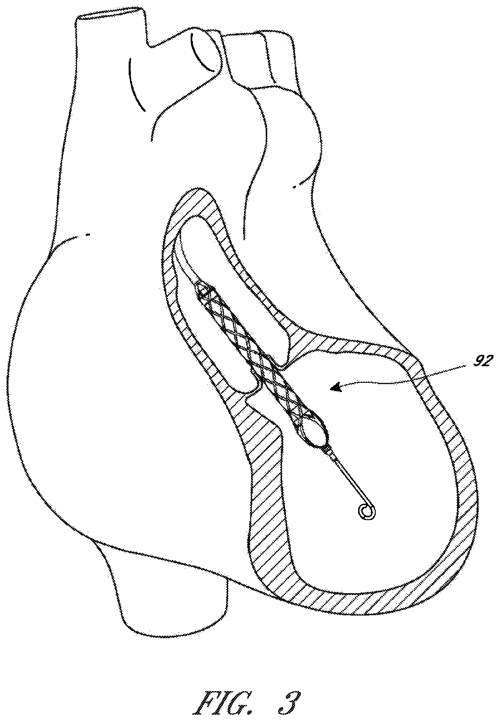 Patent US12102813 Figure 3 – Motor assembly for catheter pump