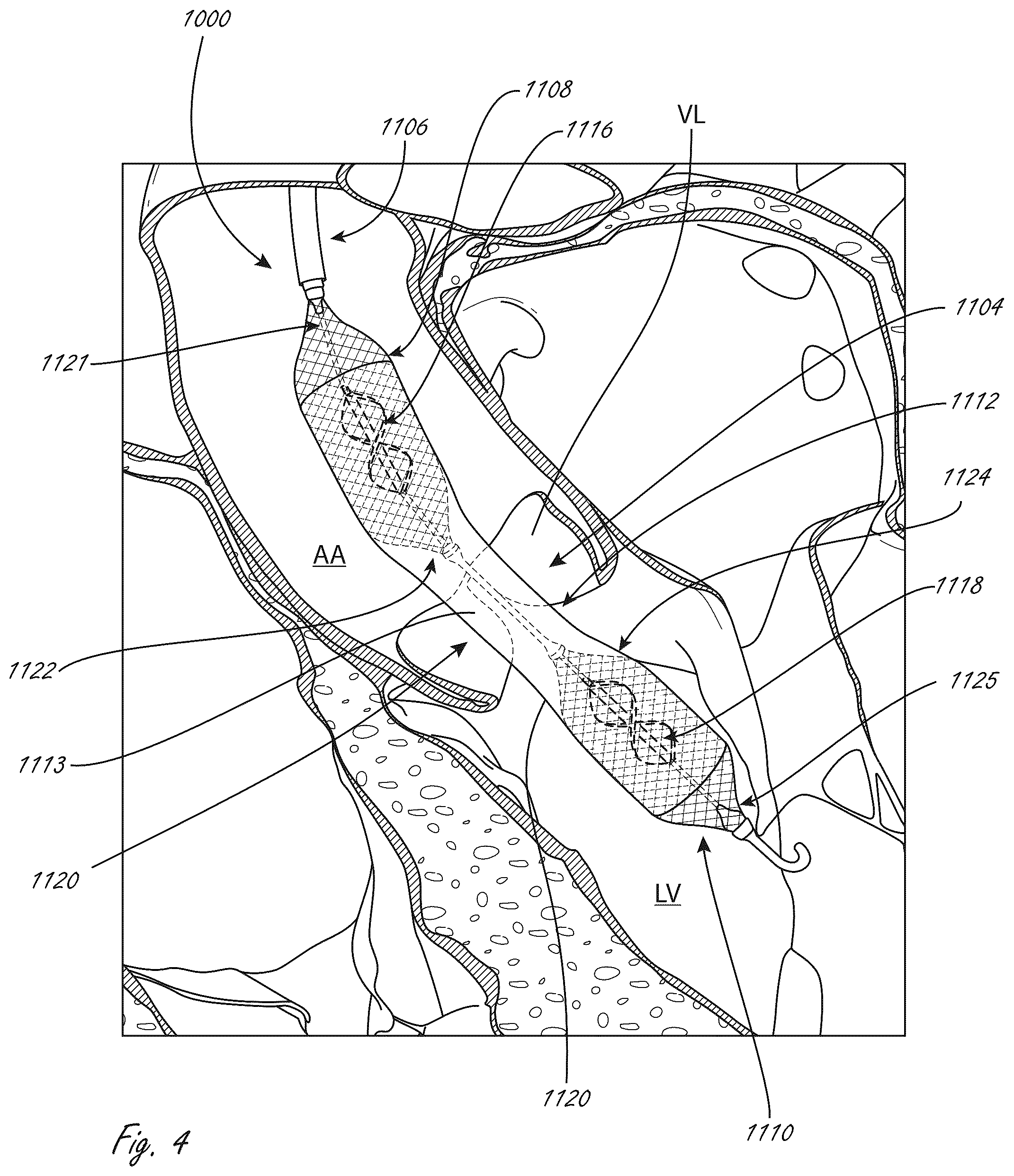 Patent US12102815 Figure 4 – Catheter blood pumps and collapsible pump housings
