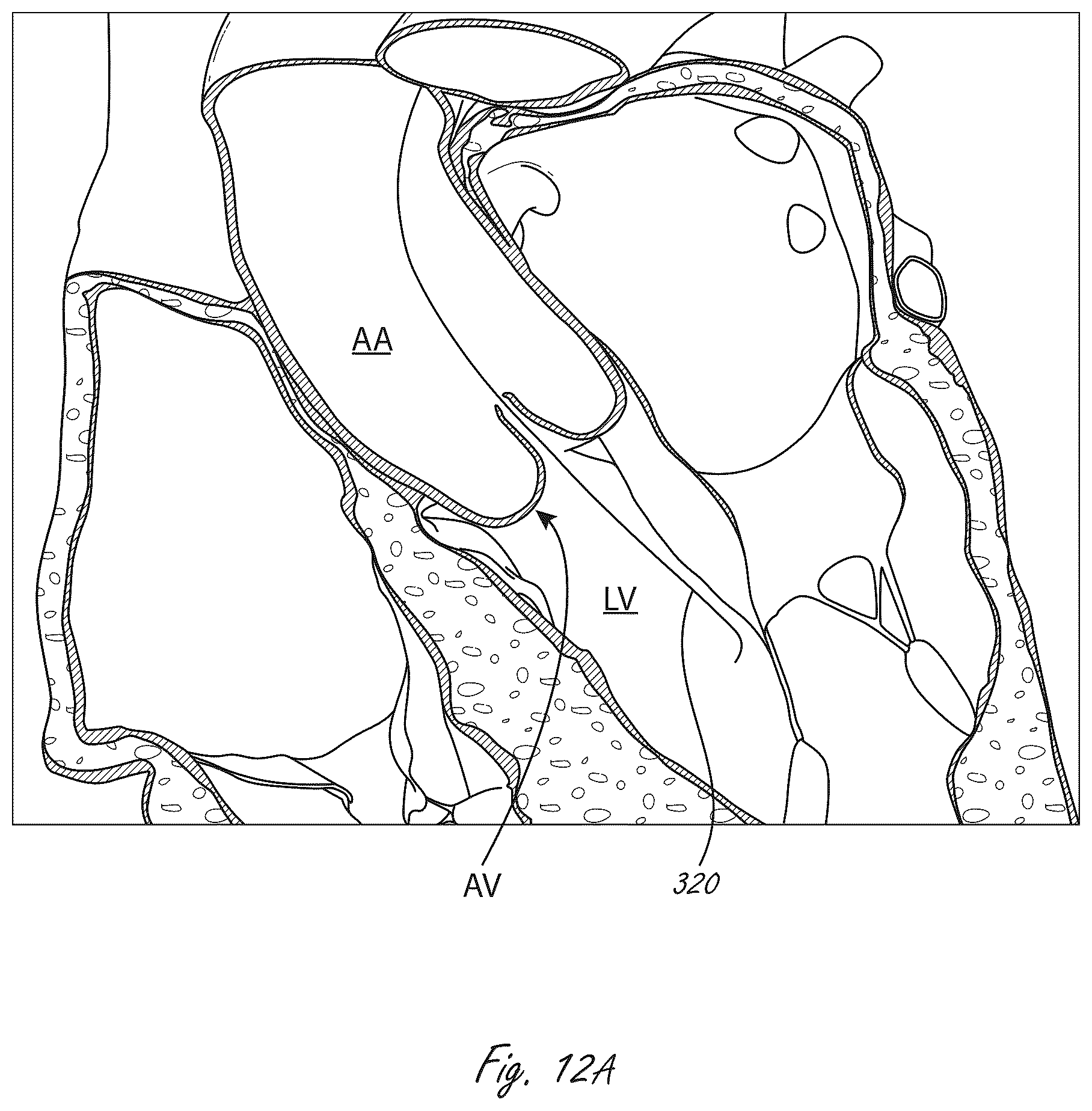 Patent US12102815 Figure 9 – Catheter blood pumps and collapsible pump housings