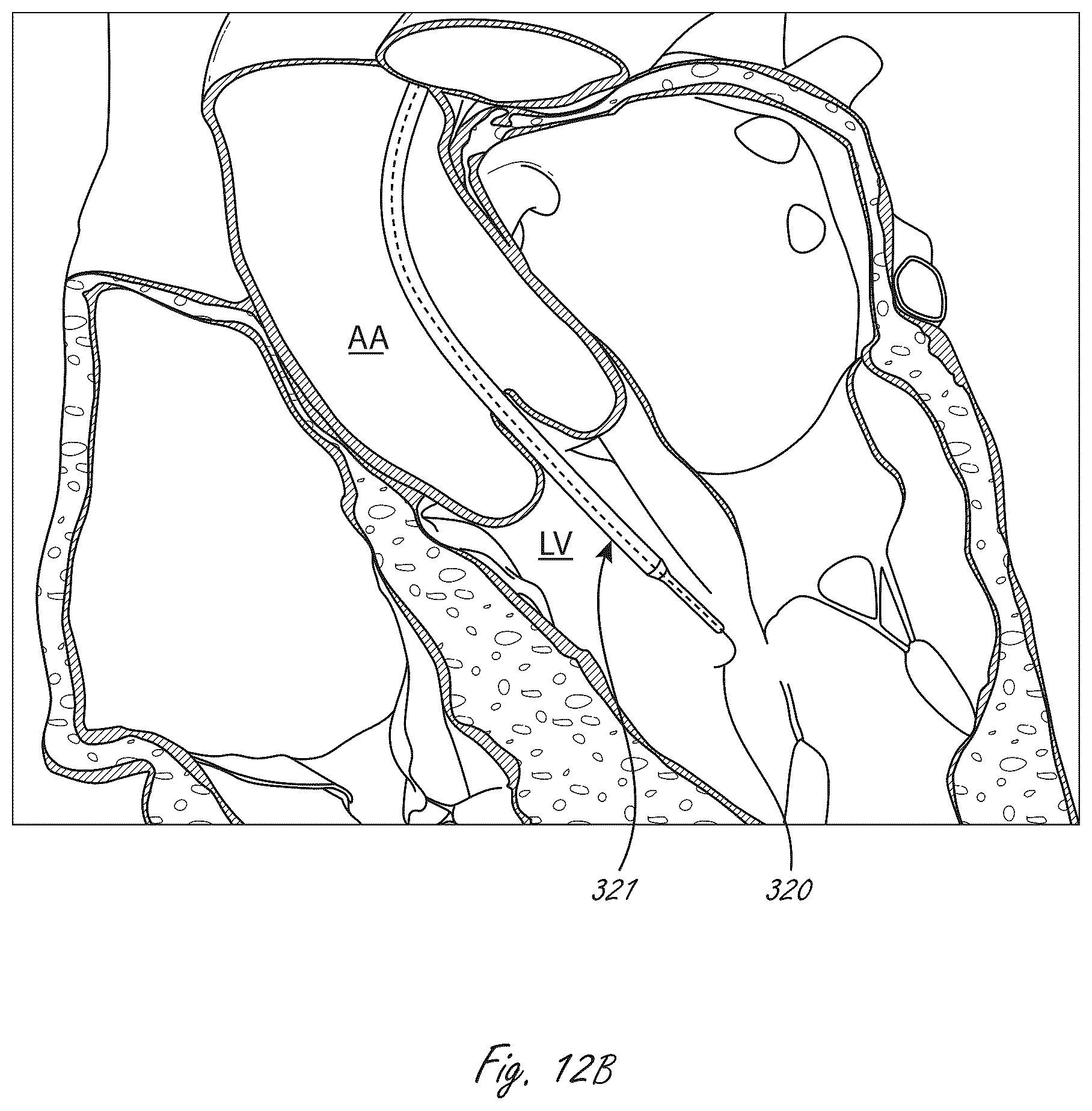 Patent US12102815 Figure 10 – Catheter blood pumps and collapsible pump housings