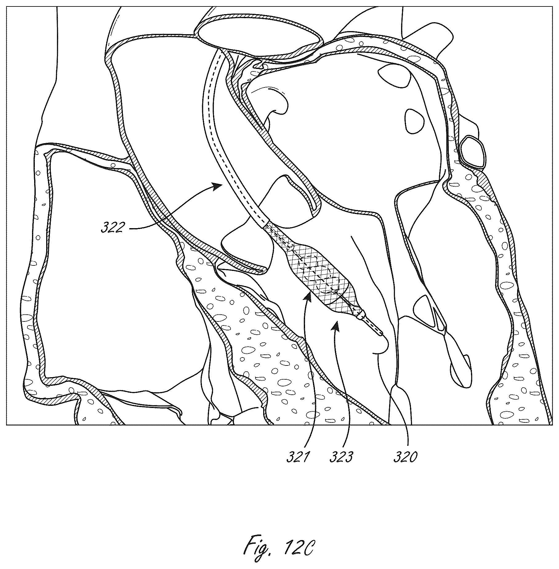 Patent US12102815 Figure 11 – Catheter blood pumps and collapsible pump housings