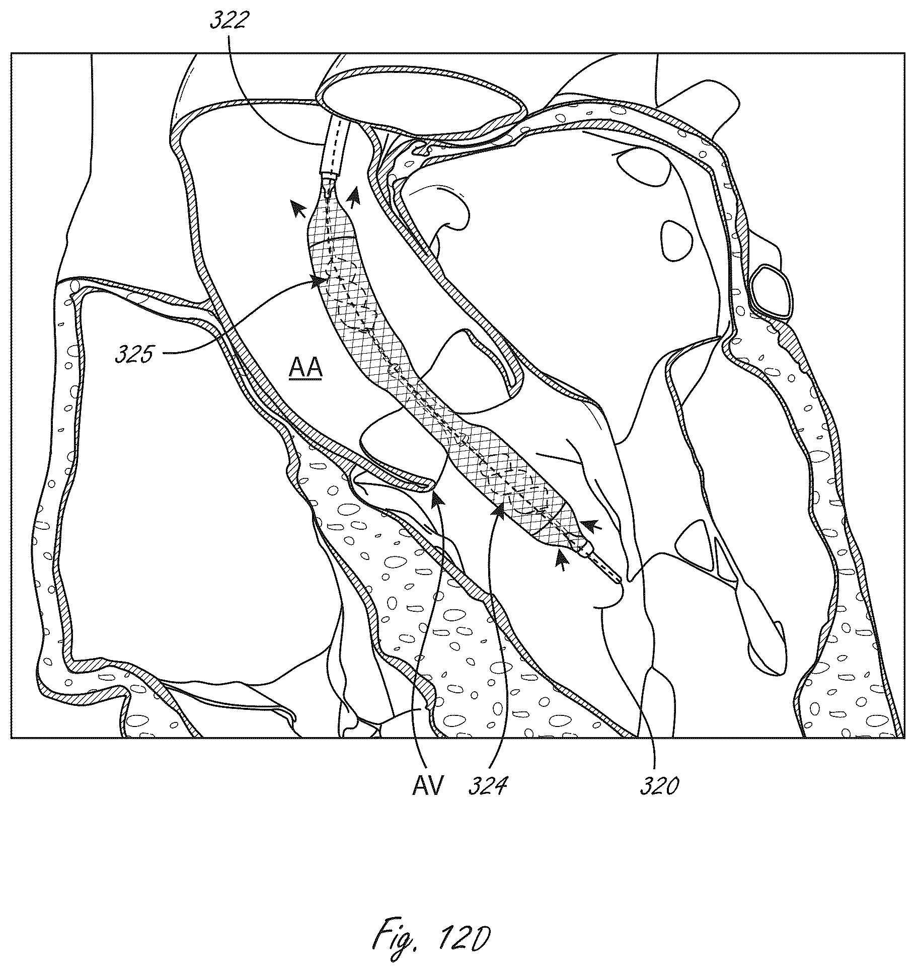 Patent US12102815 Figure 12 – Catheter blood pumps and collapsible pump housings