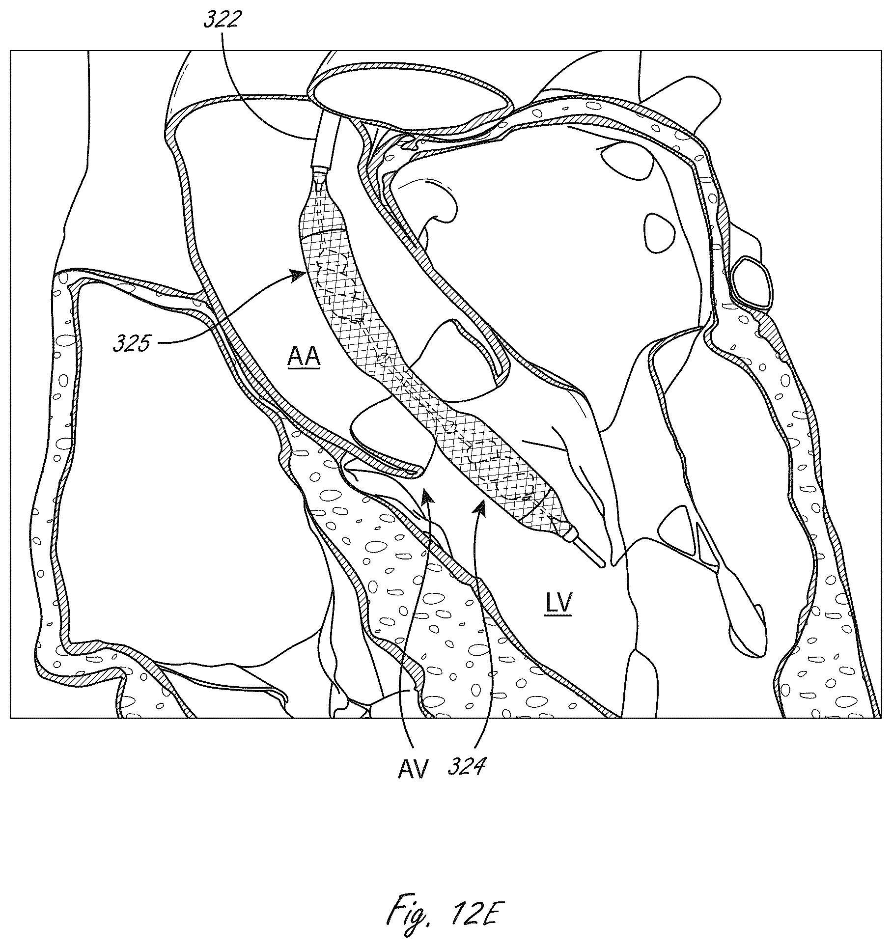 Patent US12102815 Figure 13 – Catheter blood pumps and collapsible pump housings