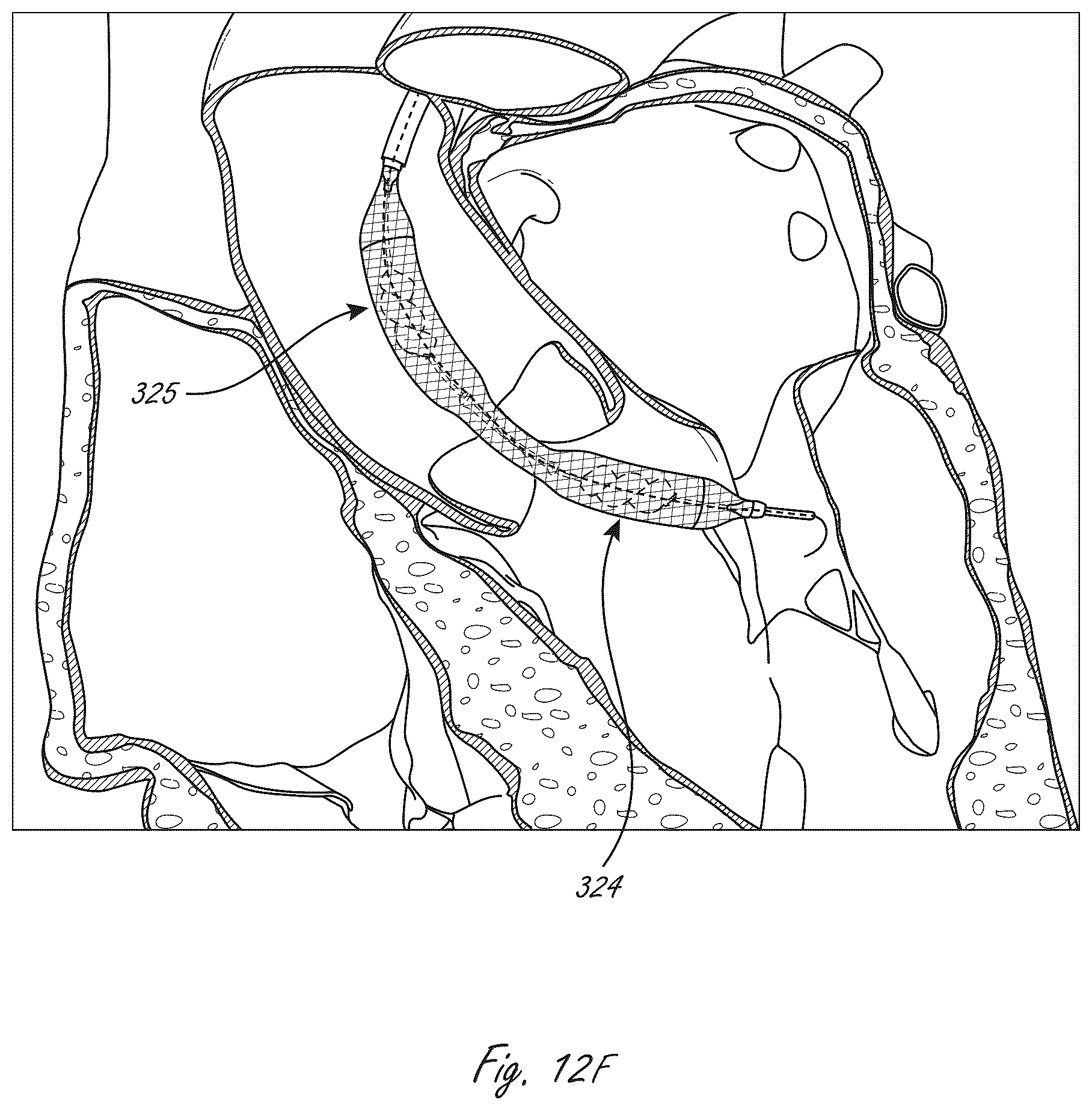 Patent US12102815 Figure 14 – Catheter blood pumps and collapsible pump housings
