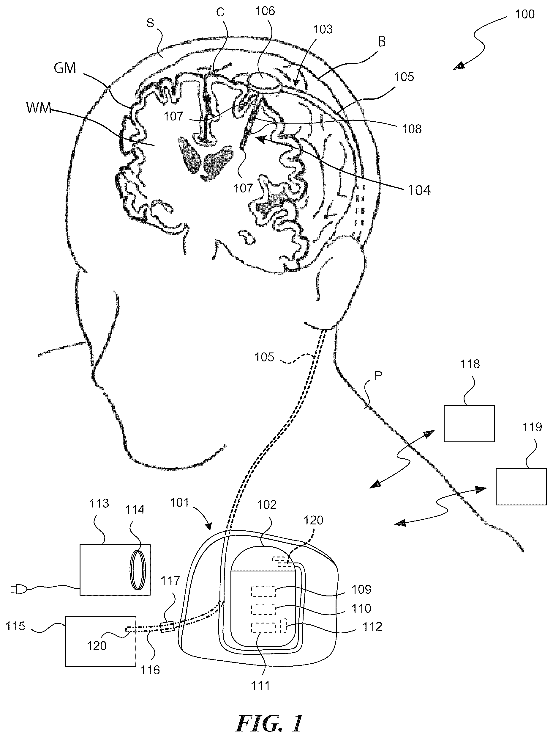 Patent US12102820 Figure 1 – Electrical therapy applied to the brain with increased efficacy and/or decreased undesirable side effects, and associated systems and methods
