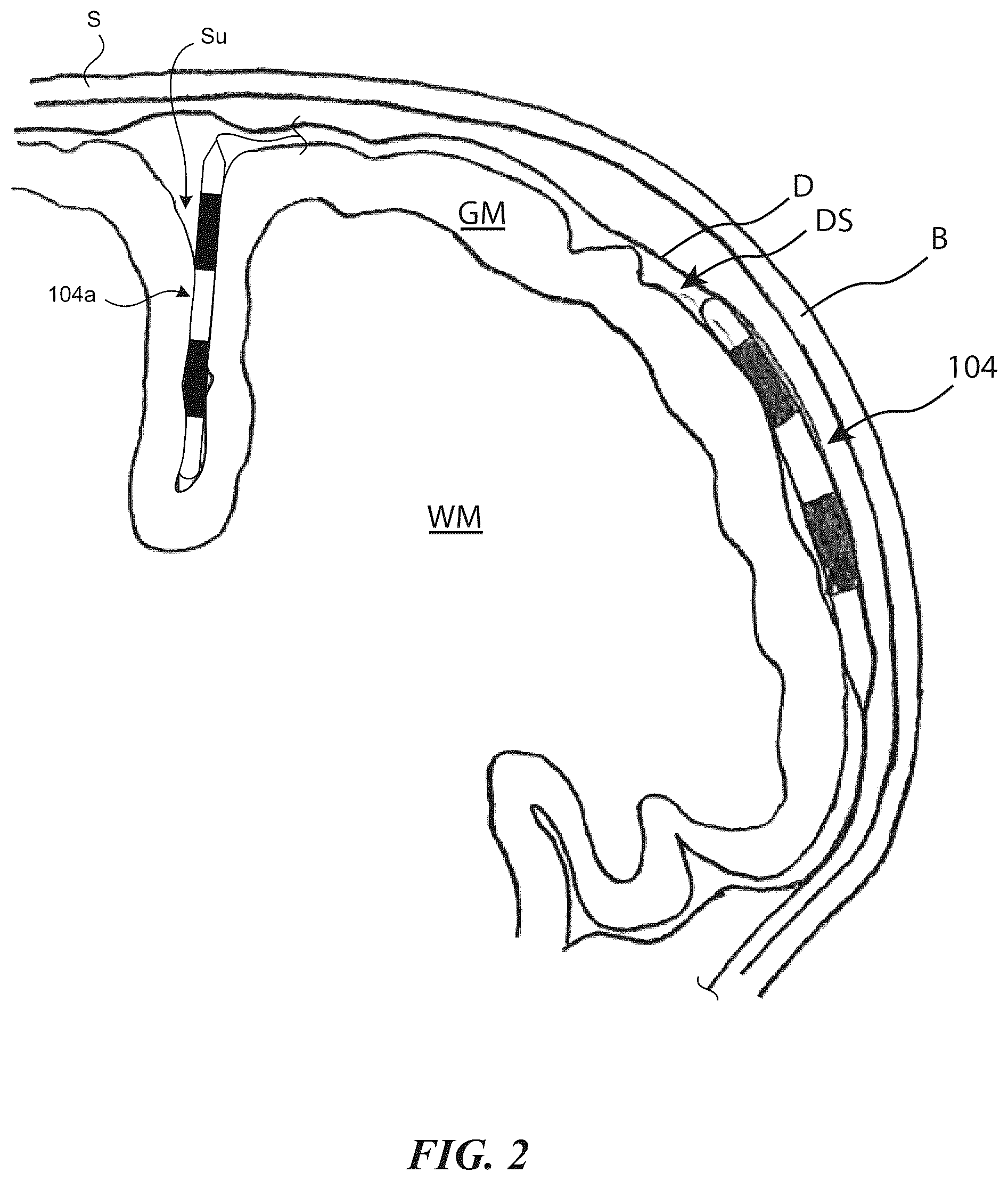 Patent US12102820 Figure 2 – Electrical therapy applied to the brain with increased efficacy and/or decreased undesirable side effects, and associated systems and methods