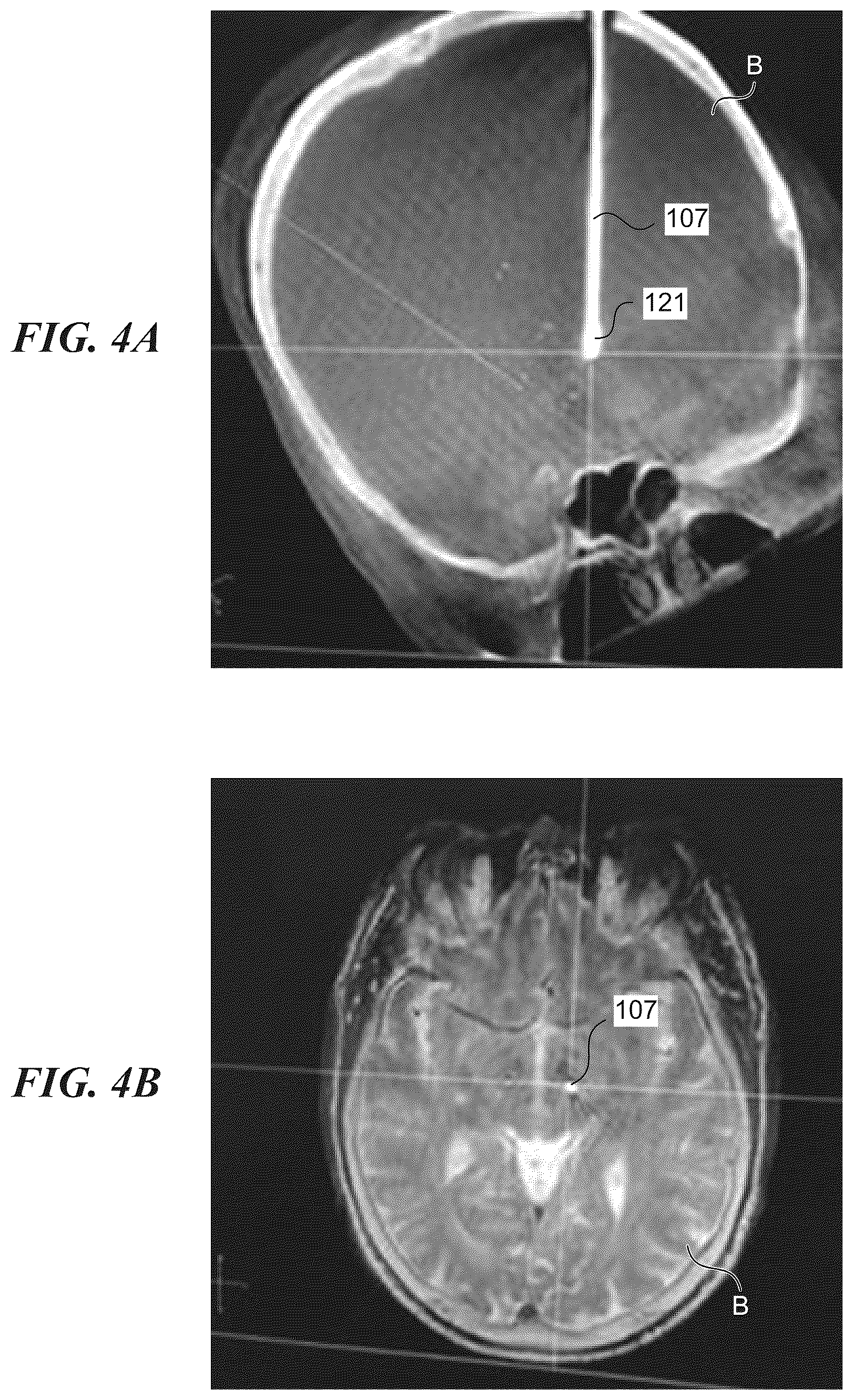 Patent US12102820 Figure 4 – Electrical therapy applied to the brain with increased efficacy and/or decreased undesirable side effects, and associated systems and methods