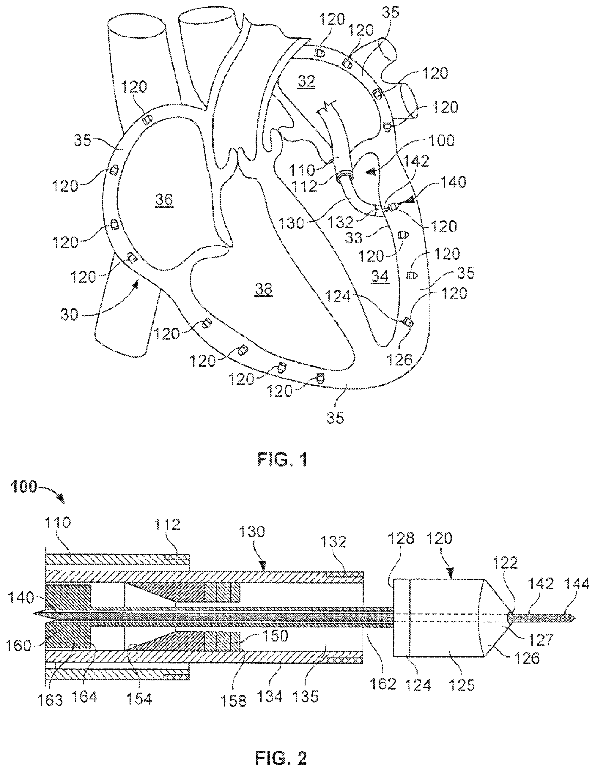 Patent US12102822 Figure 1 – Delivery of cardiac stimulation devices