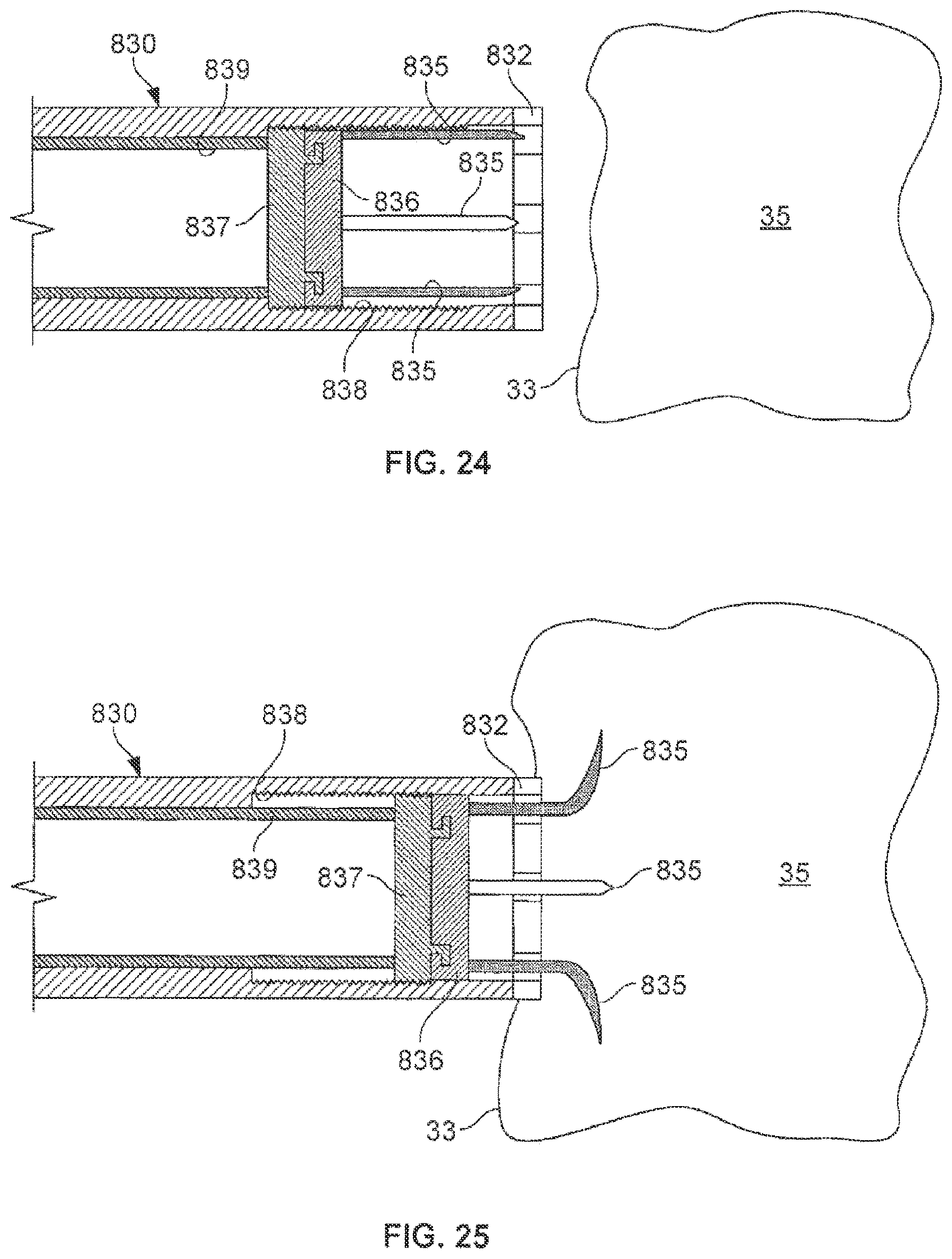 Patent US12102822 Figure 10 – Delivery of cardiac stimulation devices