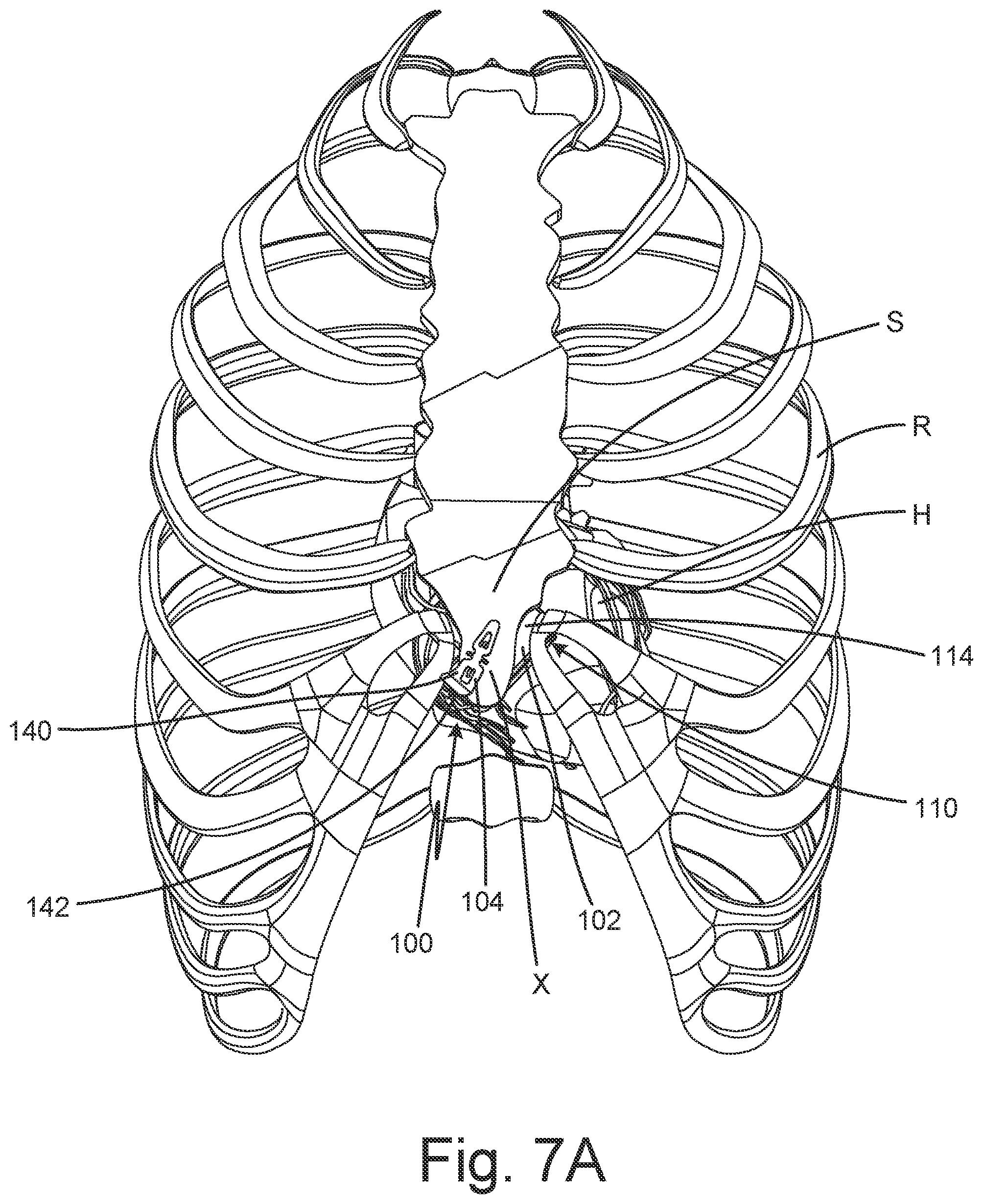 Patent US12102824 Figure 9 – Subcutaneous device for preventing and treating atherosclerosis