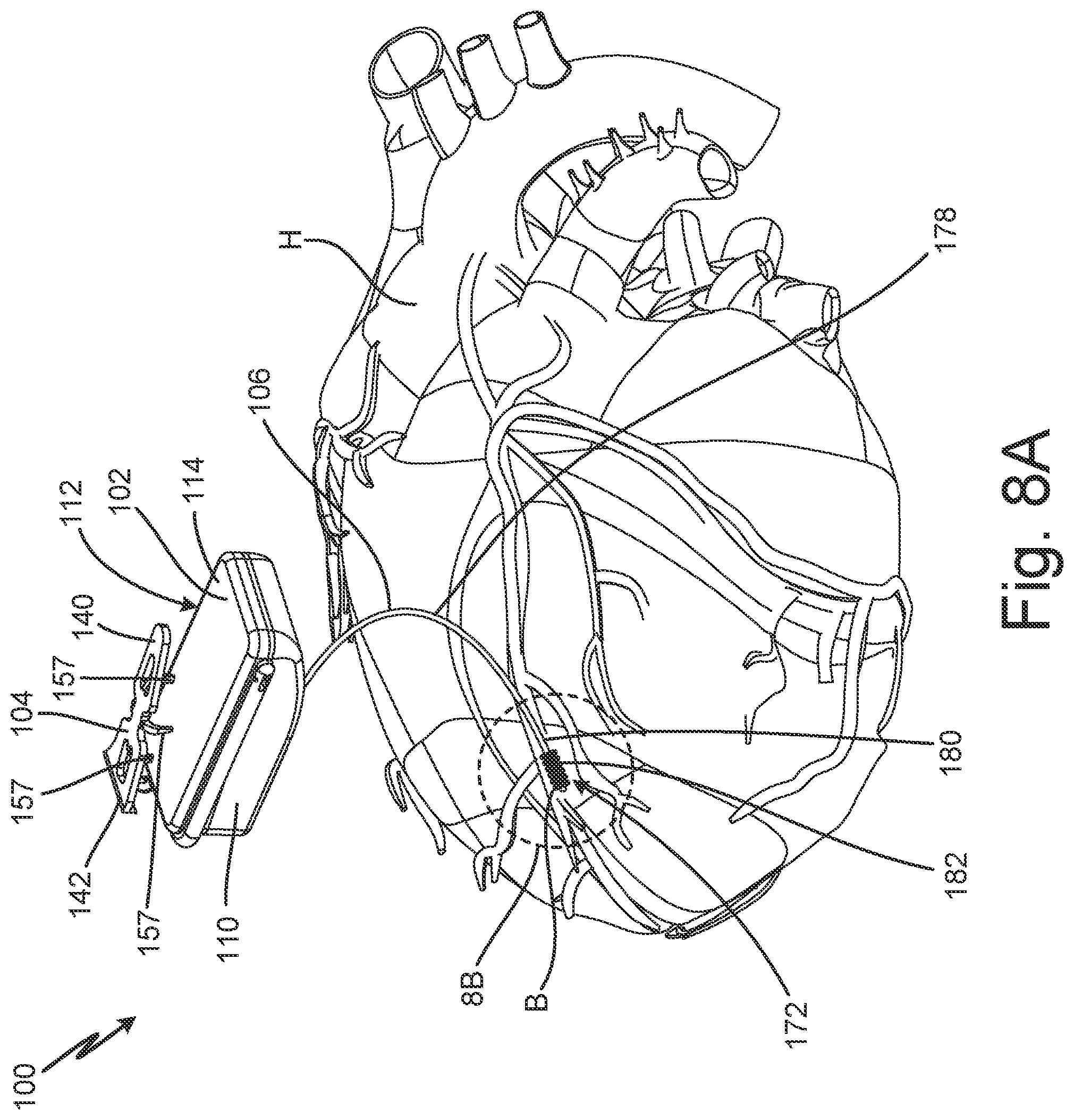 Patent US12102824 Figure 11 – Subcutaneous device for preventing and treating atherosclerosis