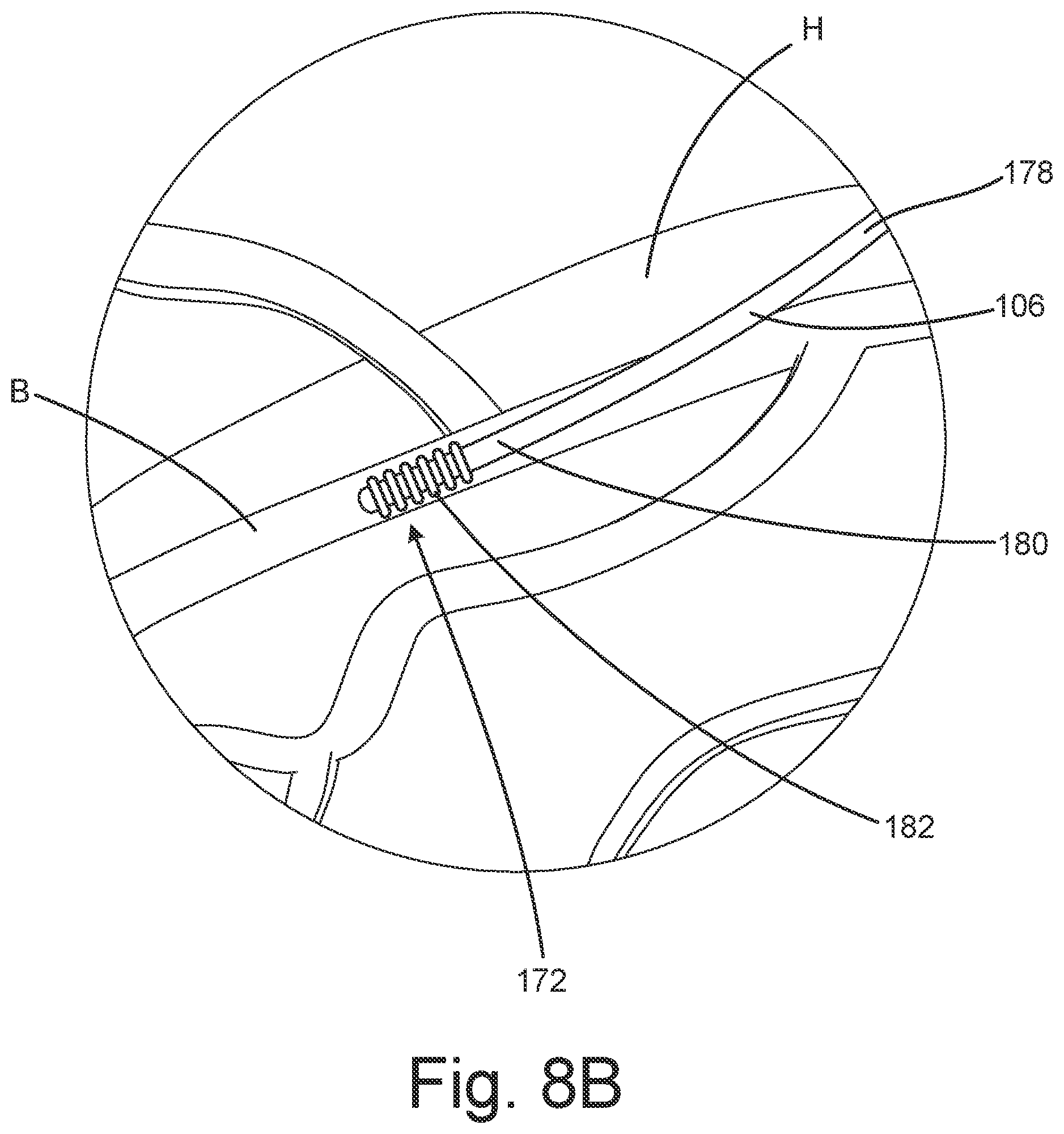 Patent US12102824 Figure 12 – Subcutaneous device for preventing and treating atherosclerosis