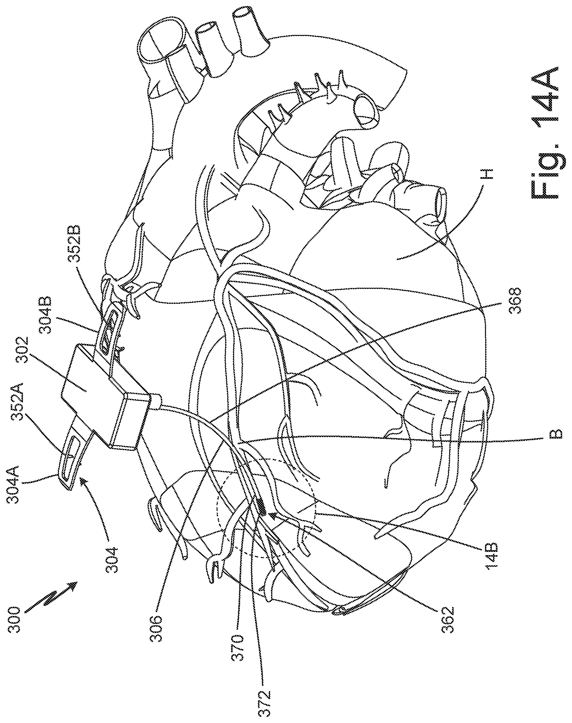 Patent US12102824 Figure 20 – Subcutaneous device for preventing and treating atherosclerosis