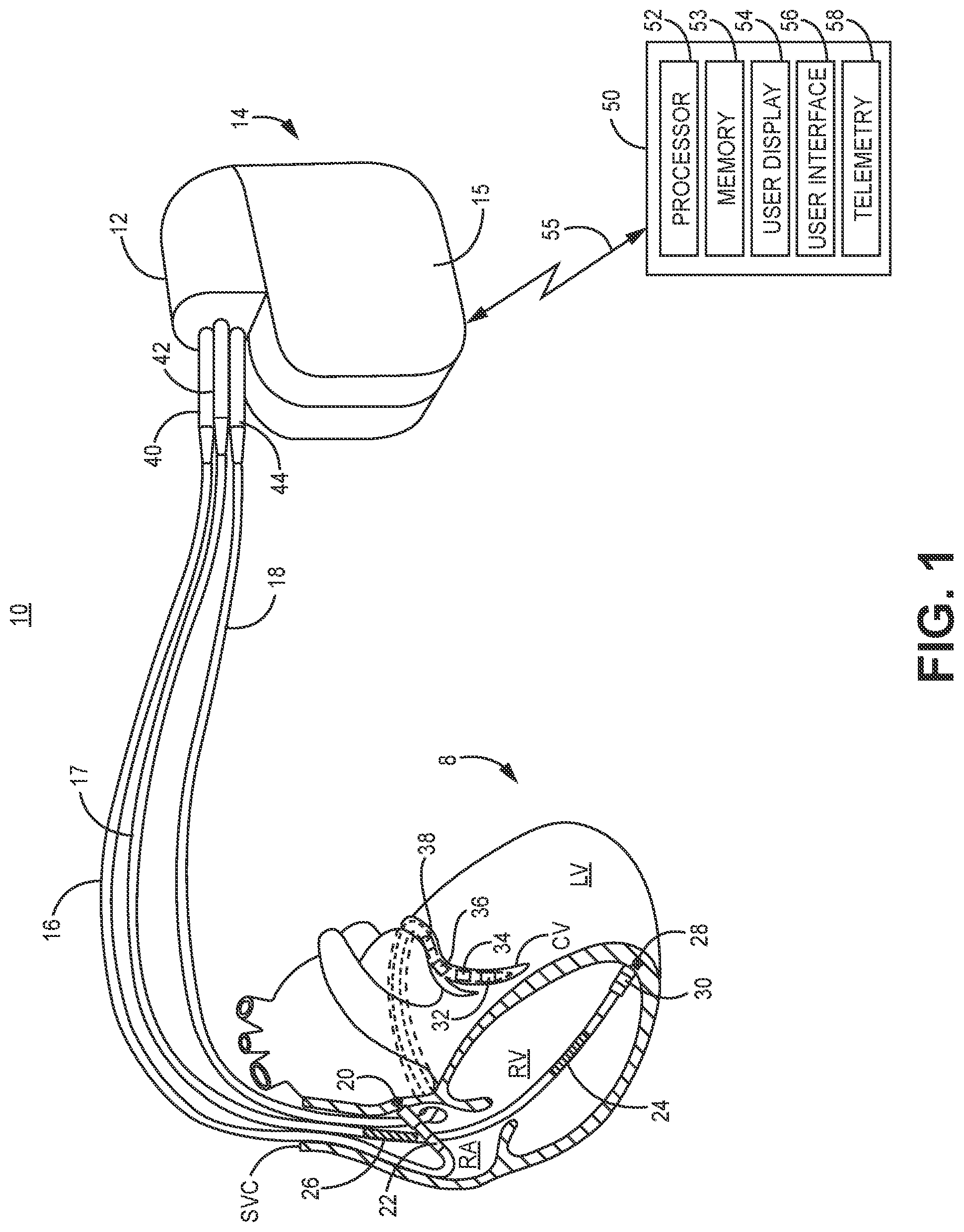 Patent US12102828 Figure 1 – T-wave morphology analysis for pathological event detection