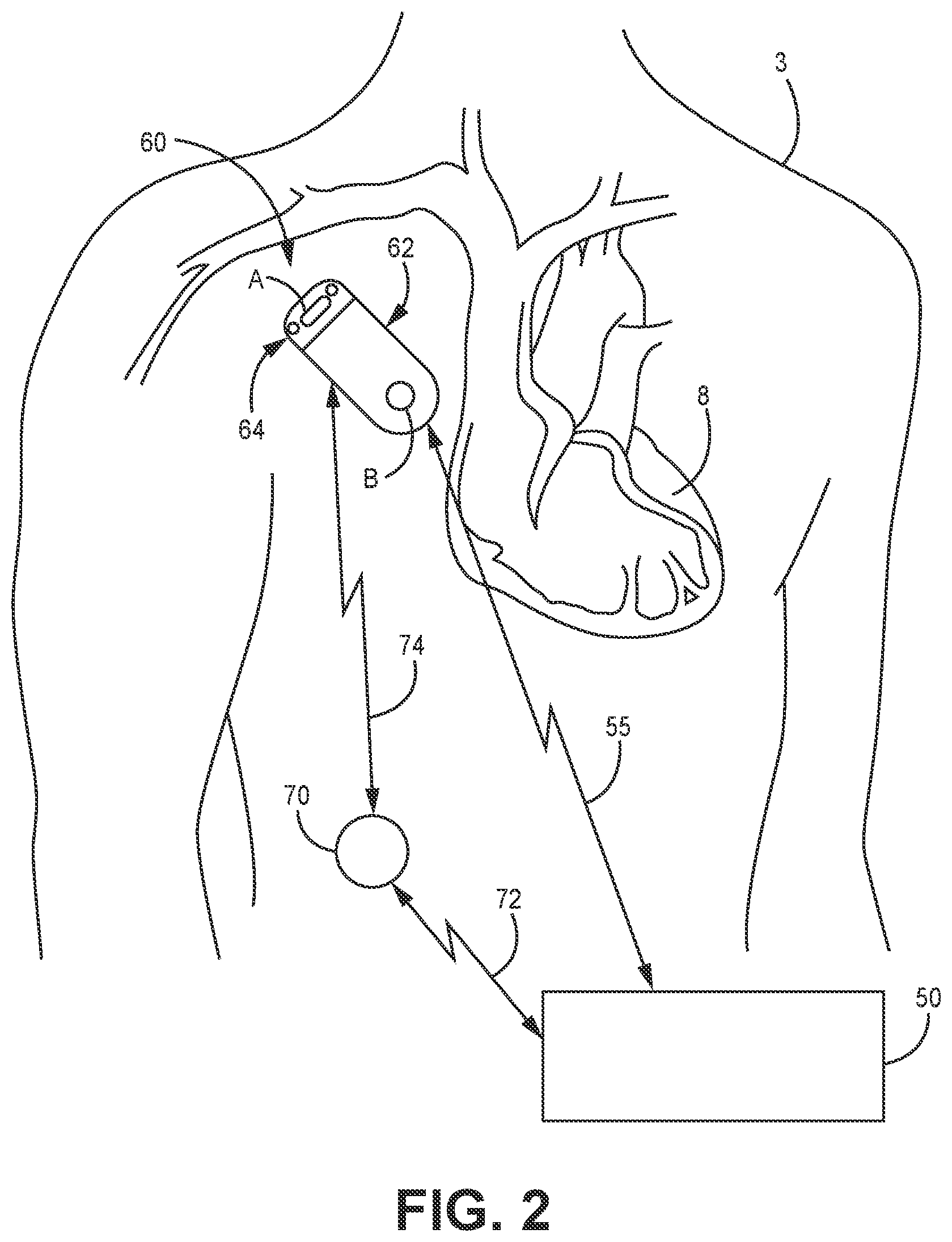 Patent US12102828 Figure 2 – T-wave morphology analysis for pathological event detection