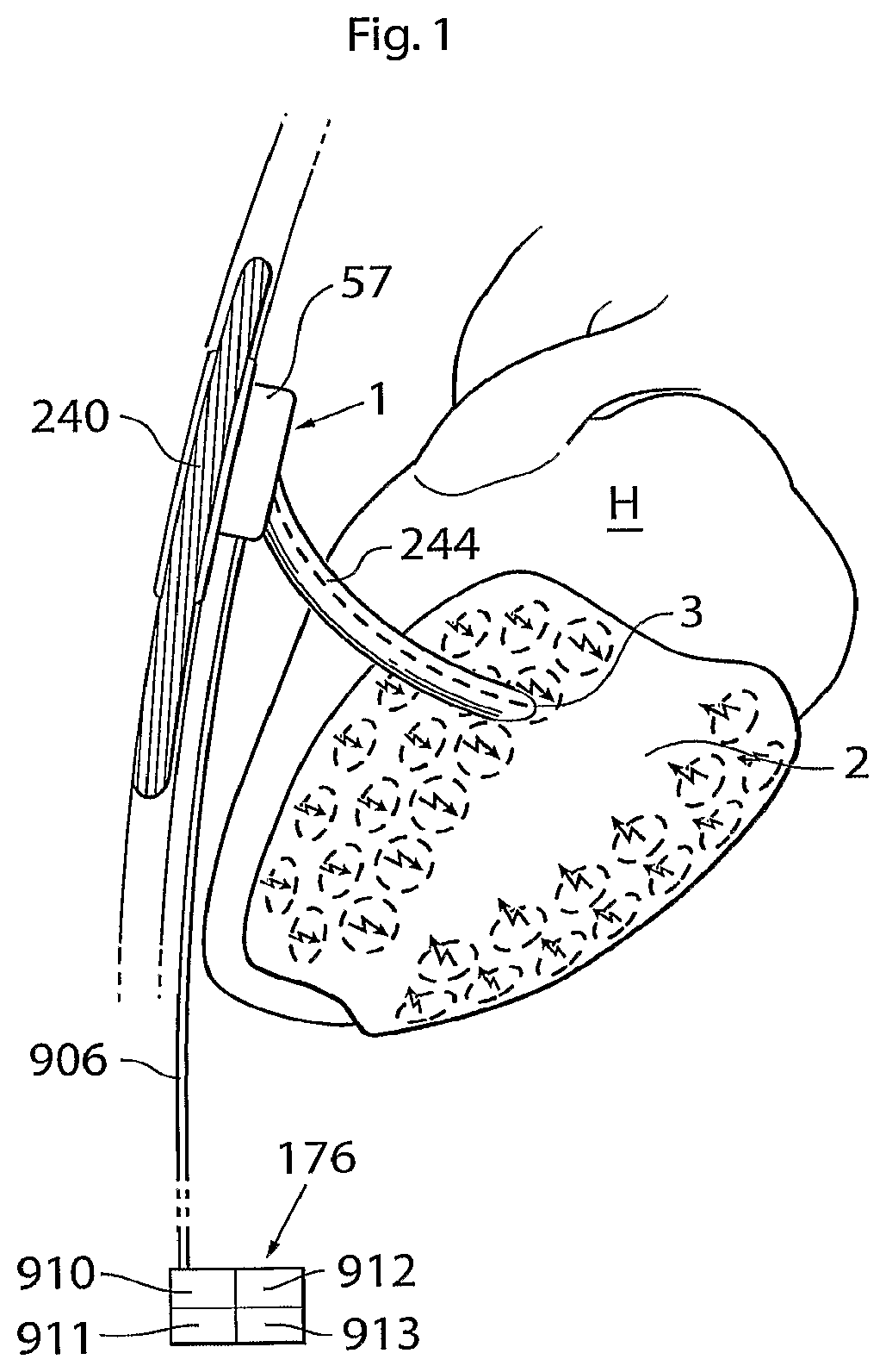 Patent US12102829 Figure 1 – Heart help device, method and system