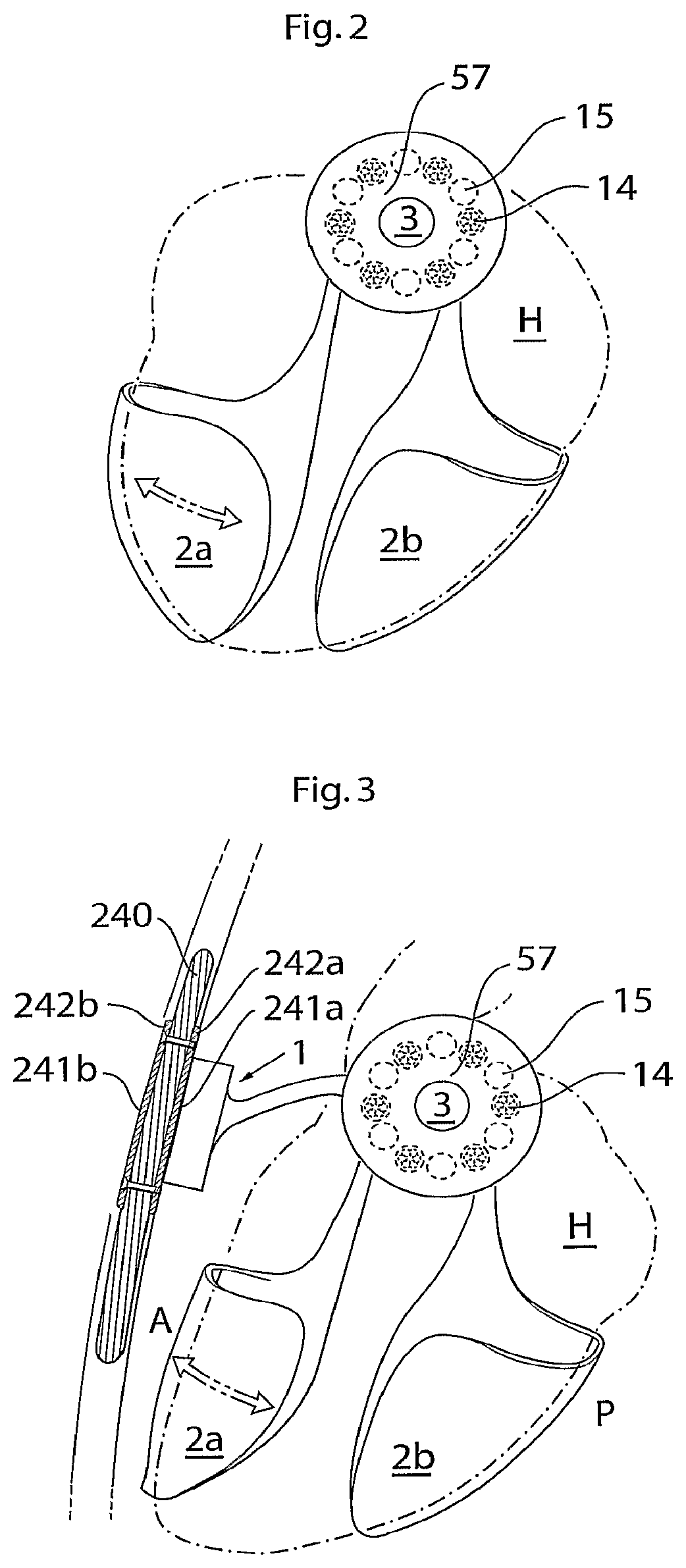 Patent US12102829 Figure 2 – Heart help device, method and system