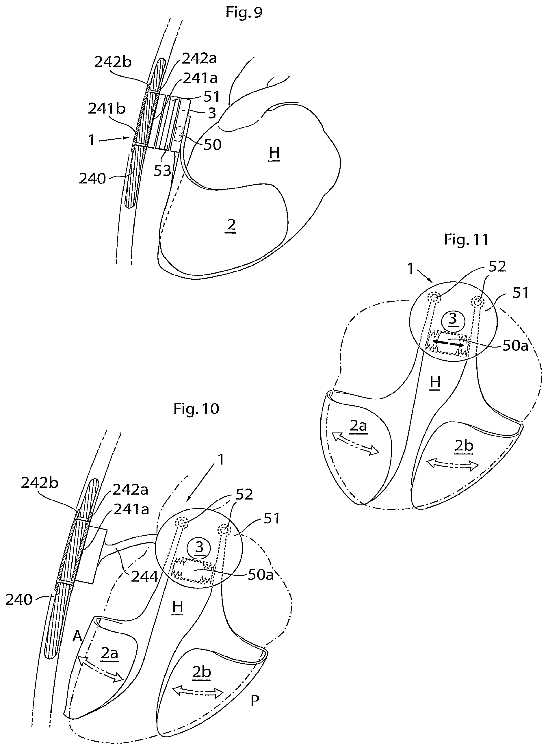 Patent US12102829 Figure 5 – Heart help device, method and system