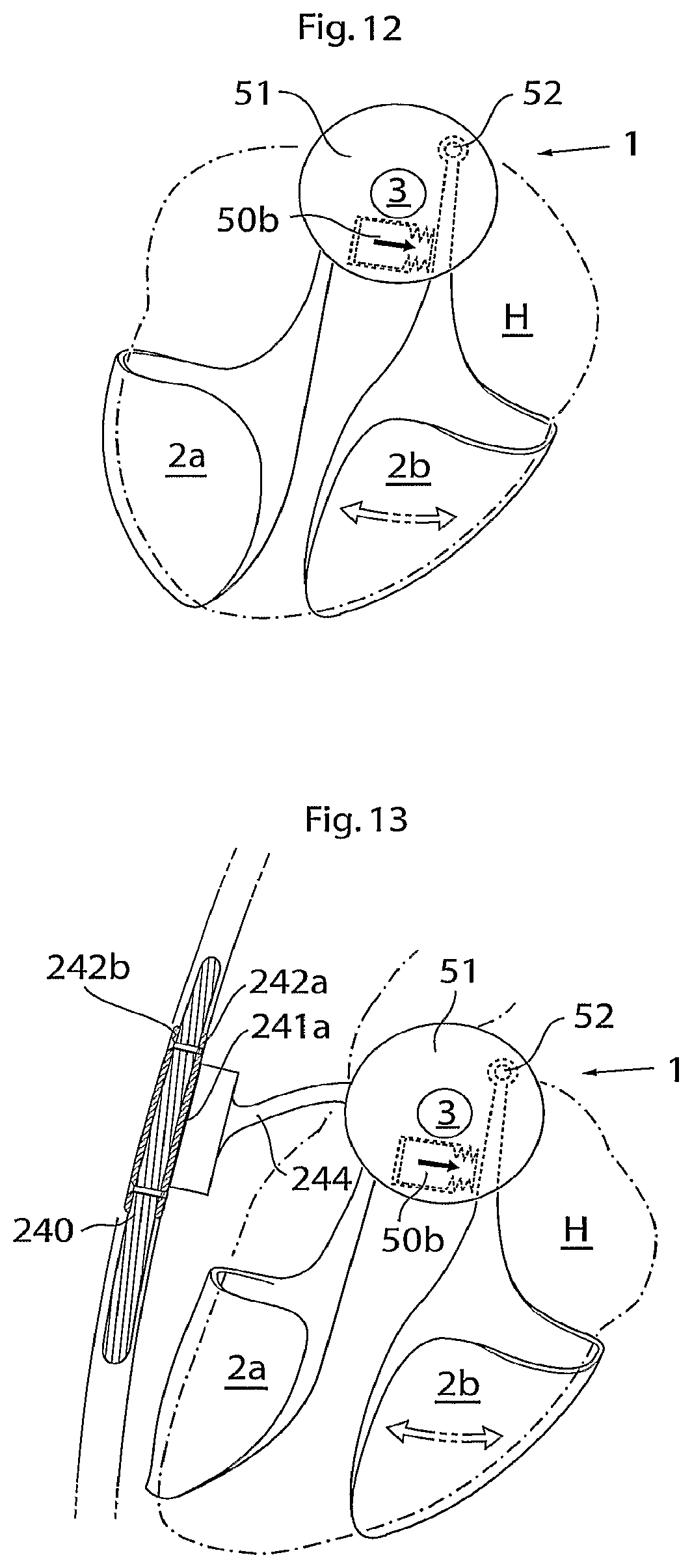 Patent US12102829 Figure 6 – Heart help device, method and system