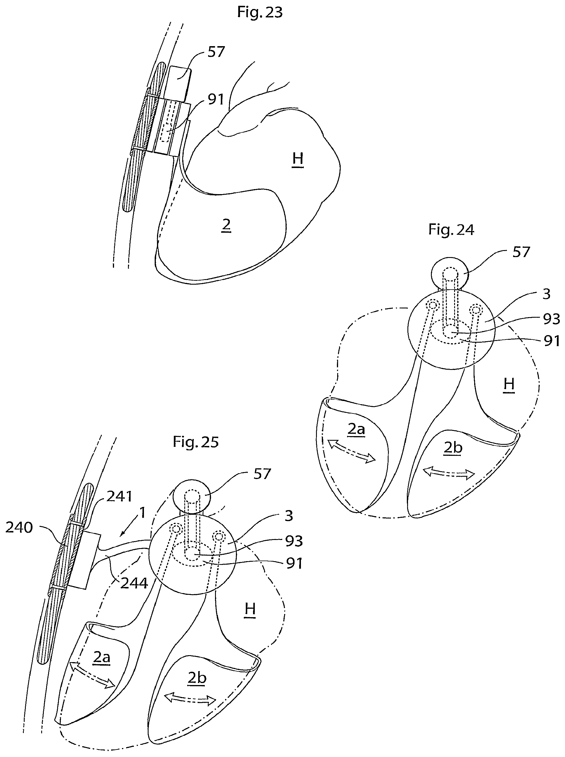 Patent US12102829 Figure 10 – Heart help device, method and system