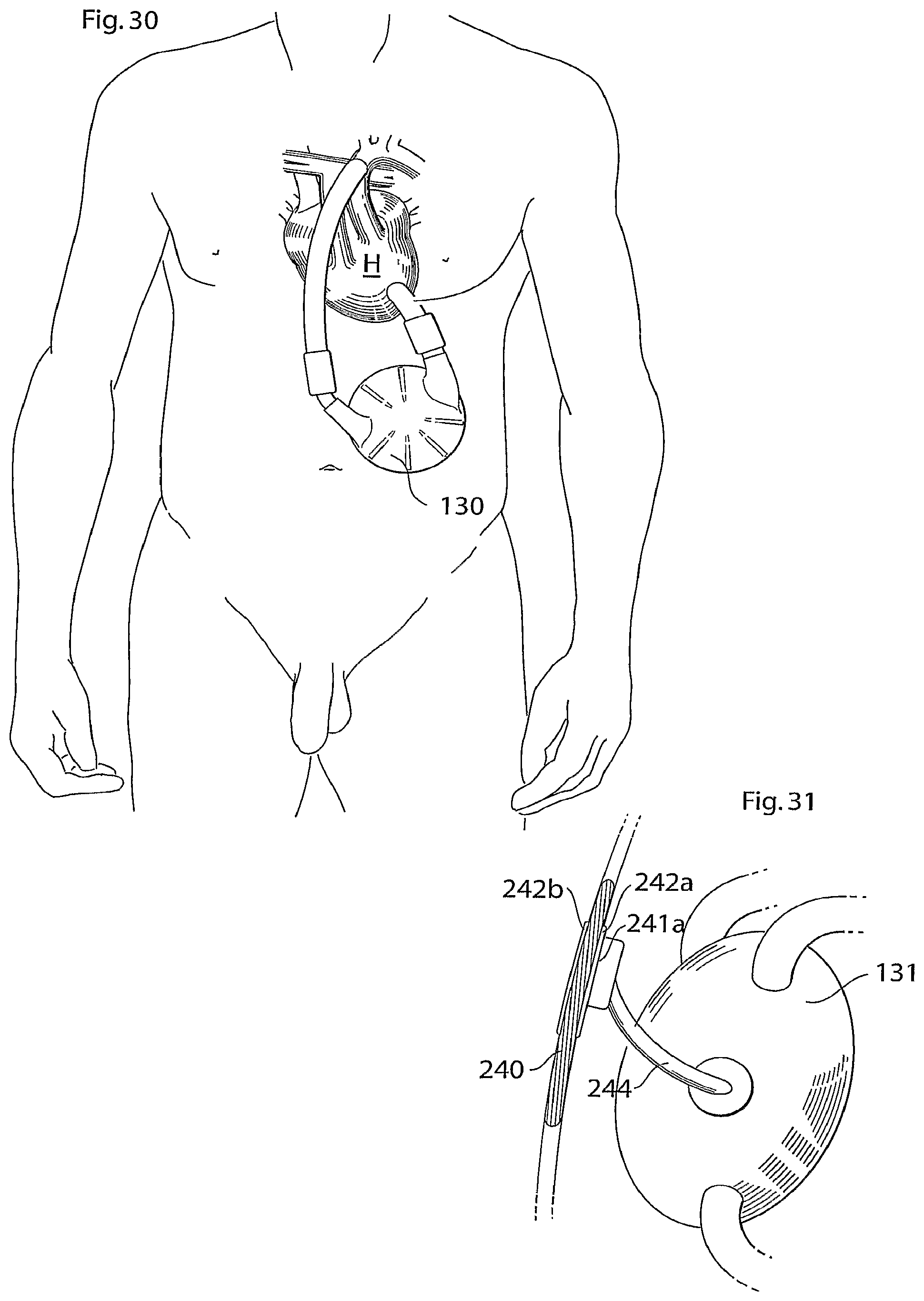 Patent US12102829 Figure 12 – Heart help device, method and system