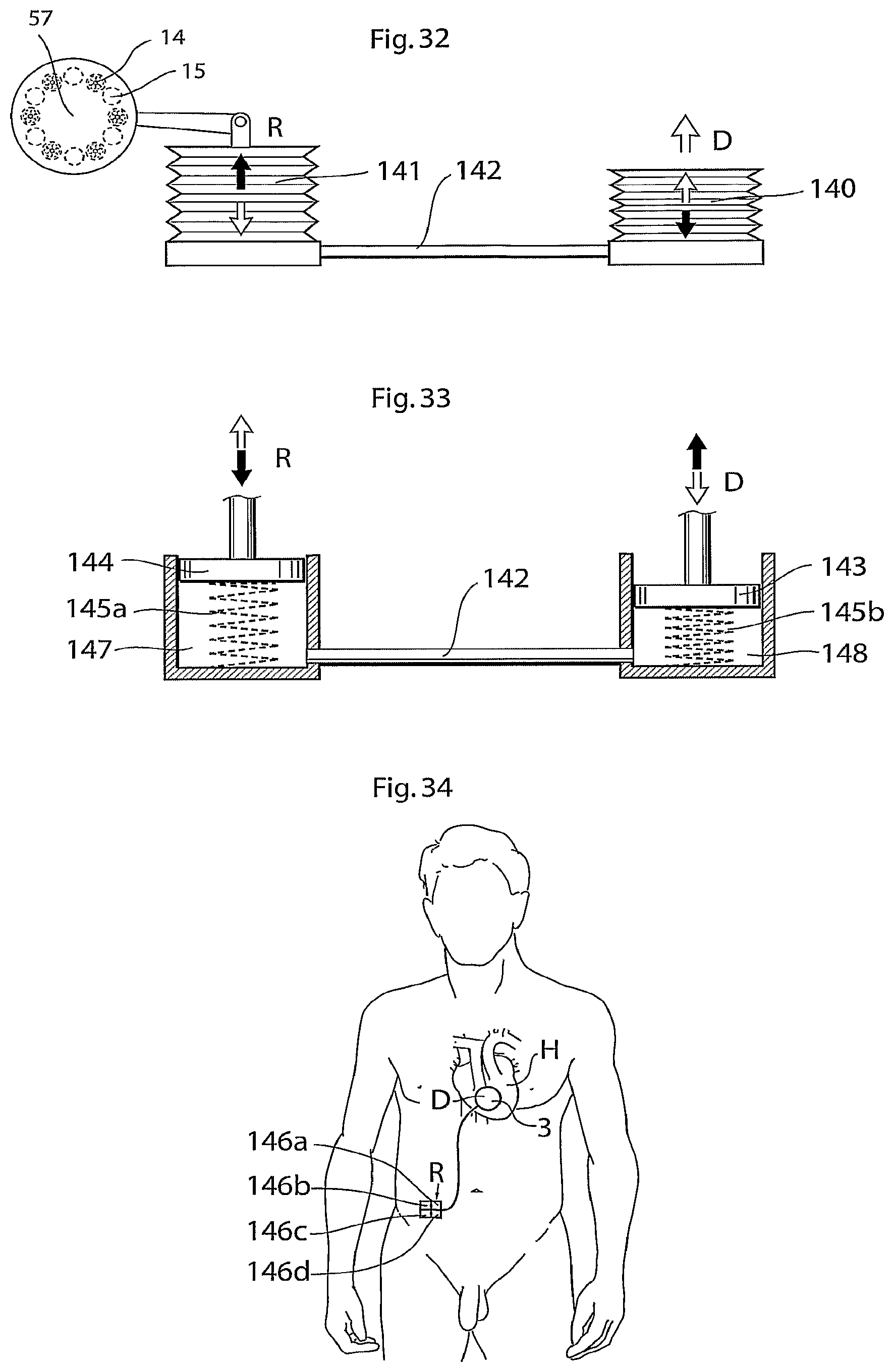 Patent US12102829 Figure 13 – Heart help device, method and system