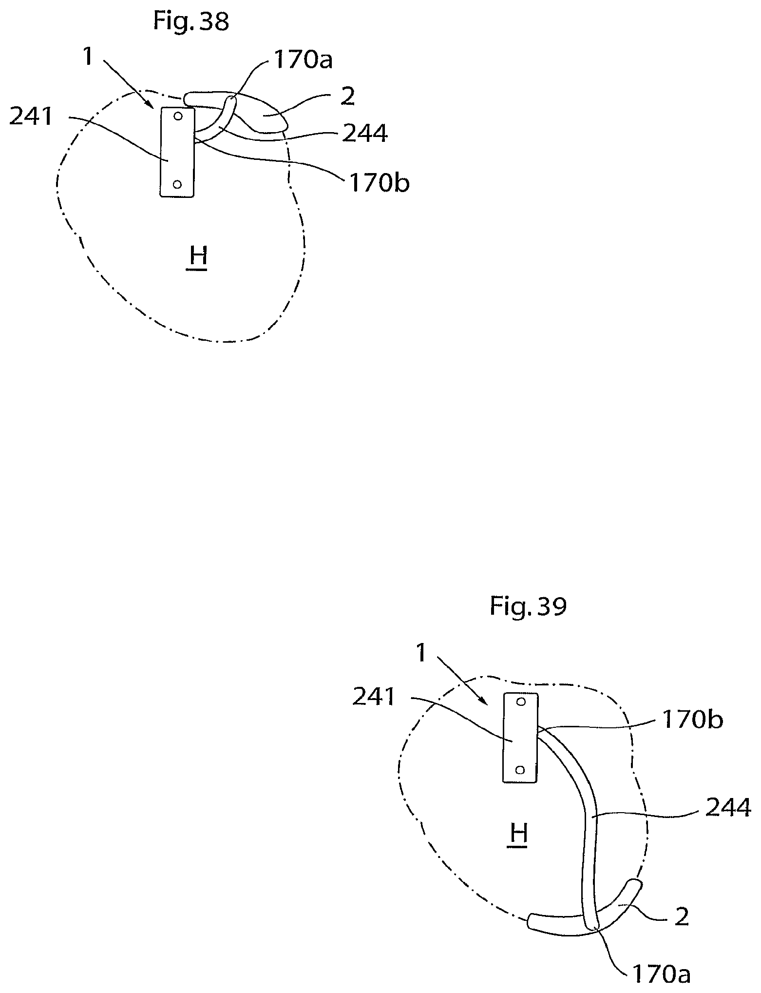 Patent US12102829 Figure 15 – Heart help device, method and system
