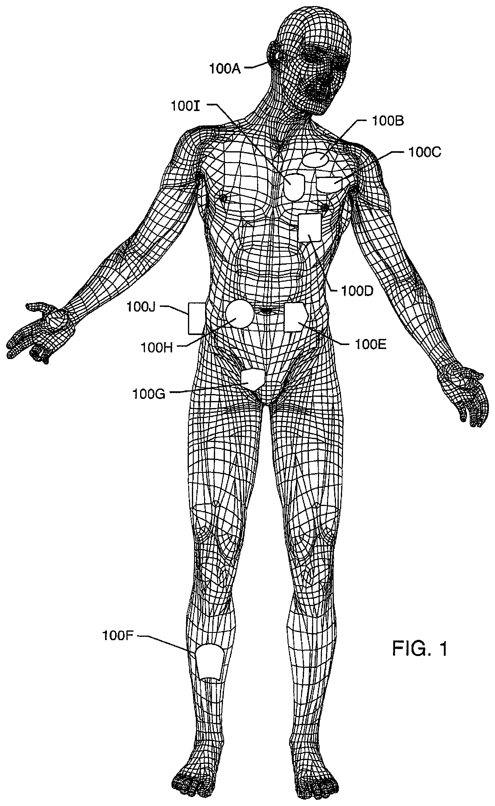 Patent US12102831 Figure 1 – Clinical static strip magnet of alternating polarities to prevent inadvertent actuation of magnet-mode in an active implantable medical device