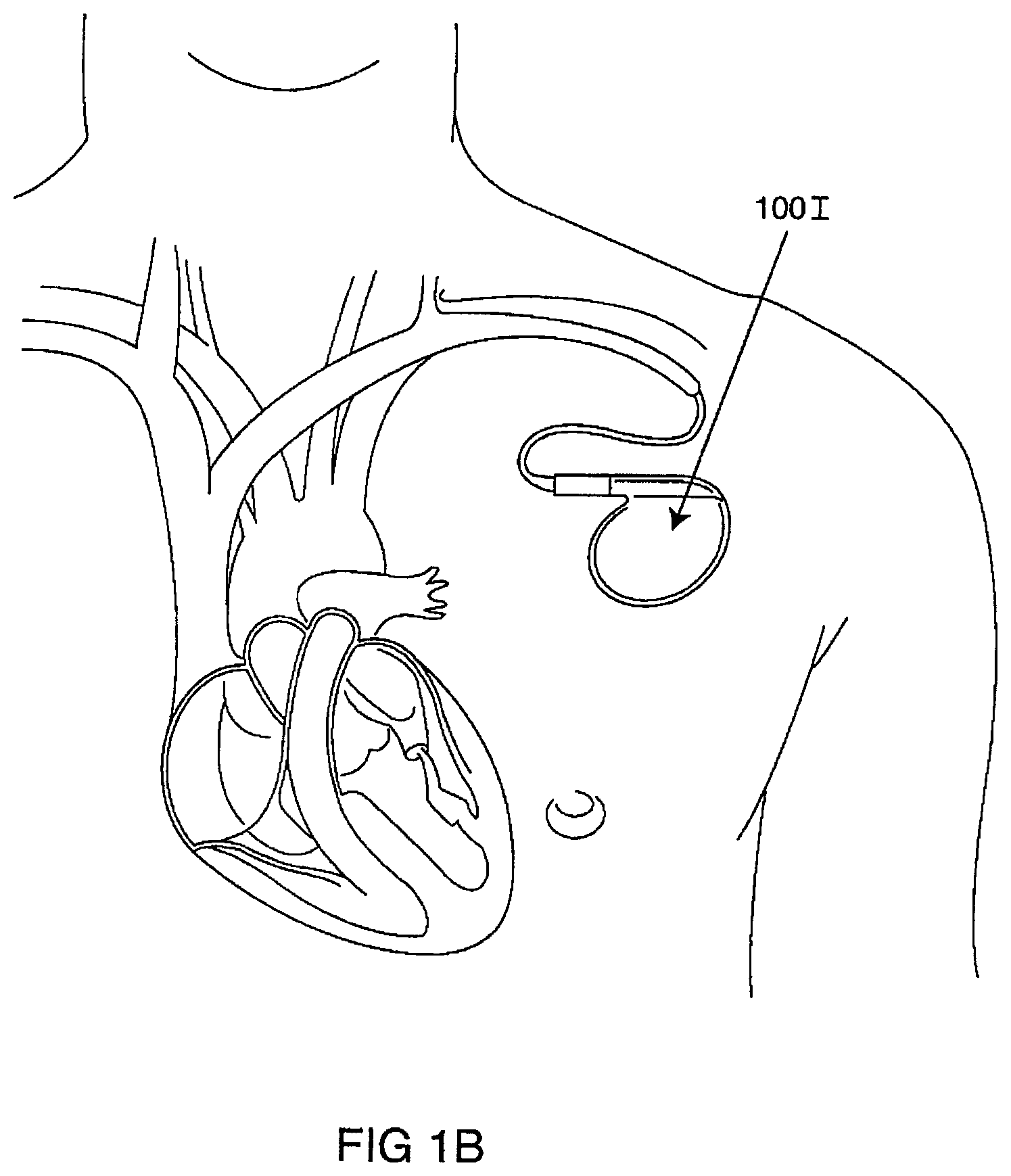 Patent US12102831 Figure 3 – Clinical static strip magnet of alternating polarities to prevent inadvertent actuation of magnet-mode in an active implantable medical device