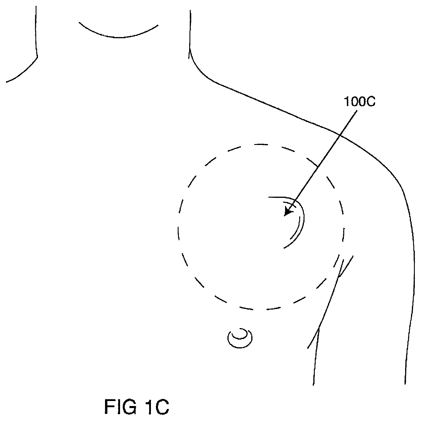 Patent US12102831 Figure 4 – Clinical static strip magnet of alternating polarities to prevent inadvertent actuation of magnet-mode in an active implantable medical device