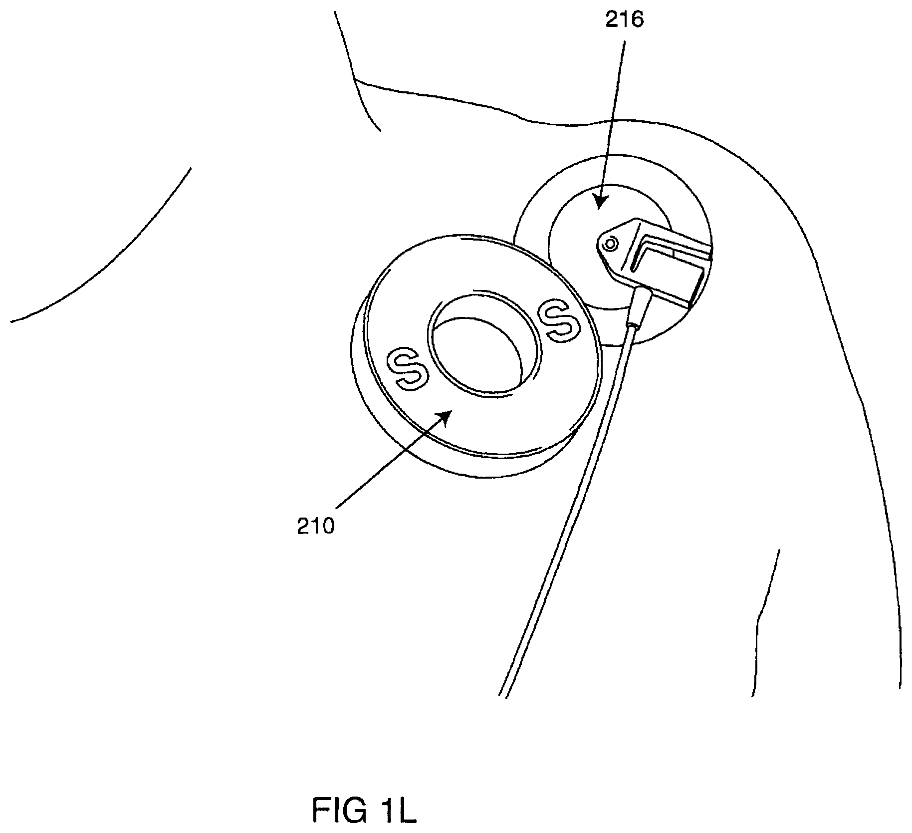Patent US12102831 Figure 12 – Clinical static strip magnet of alternating polarities to prevent inadvertent actuation of magnet-mode in an active implantable medical device