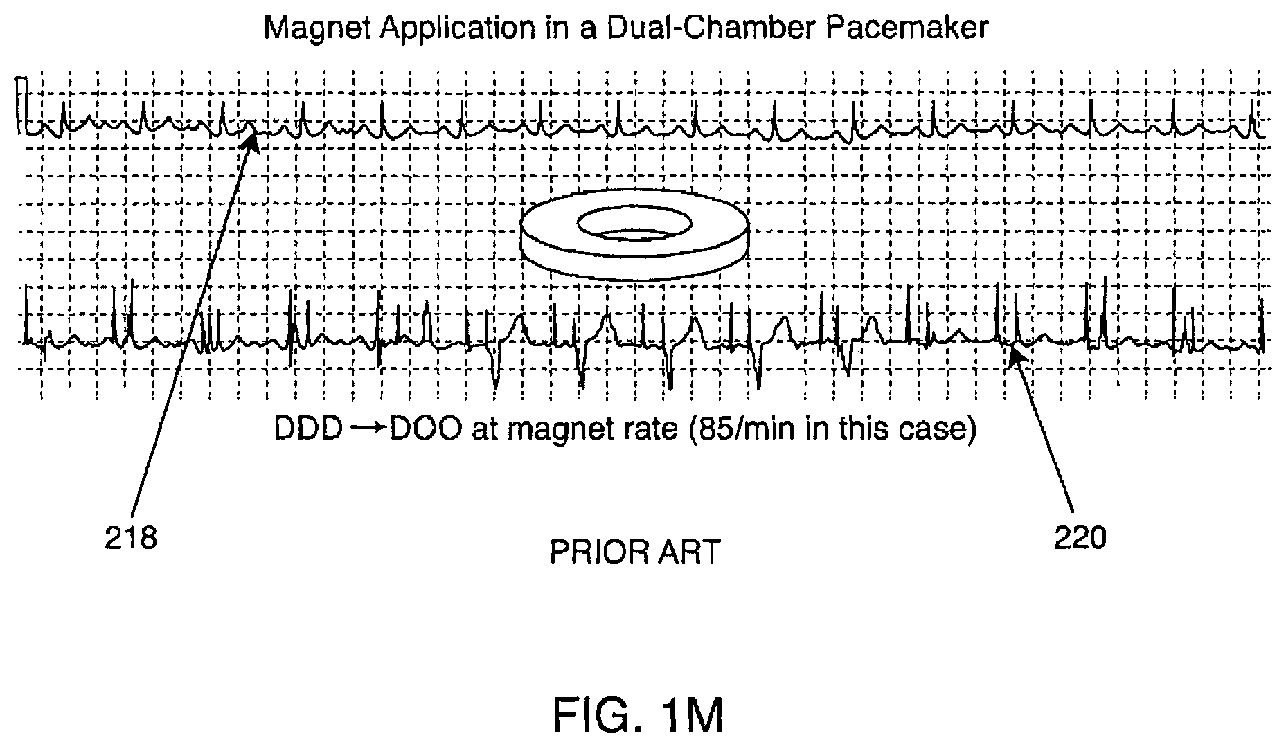 Patent US12102831 Figure 13 – Clinical static strip magnet of alternating polarities to prevent inadvertent actuation of magnet-mode in an active implantable medical device