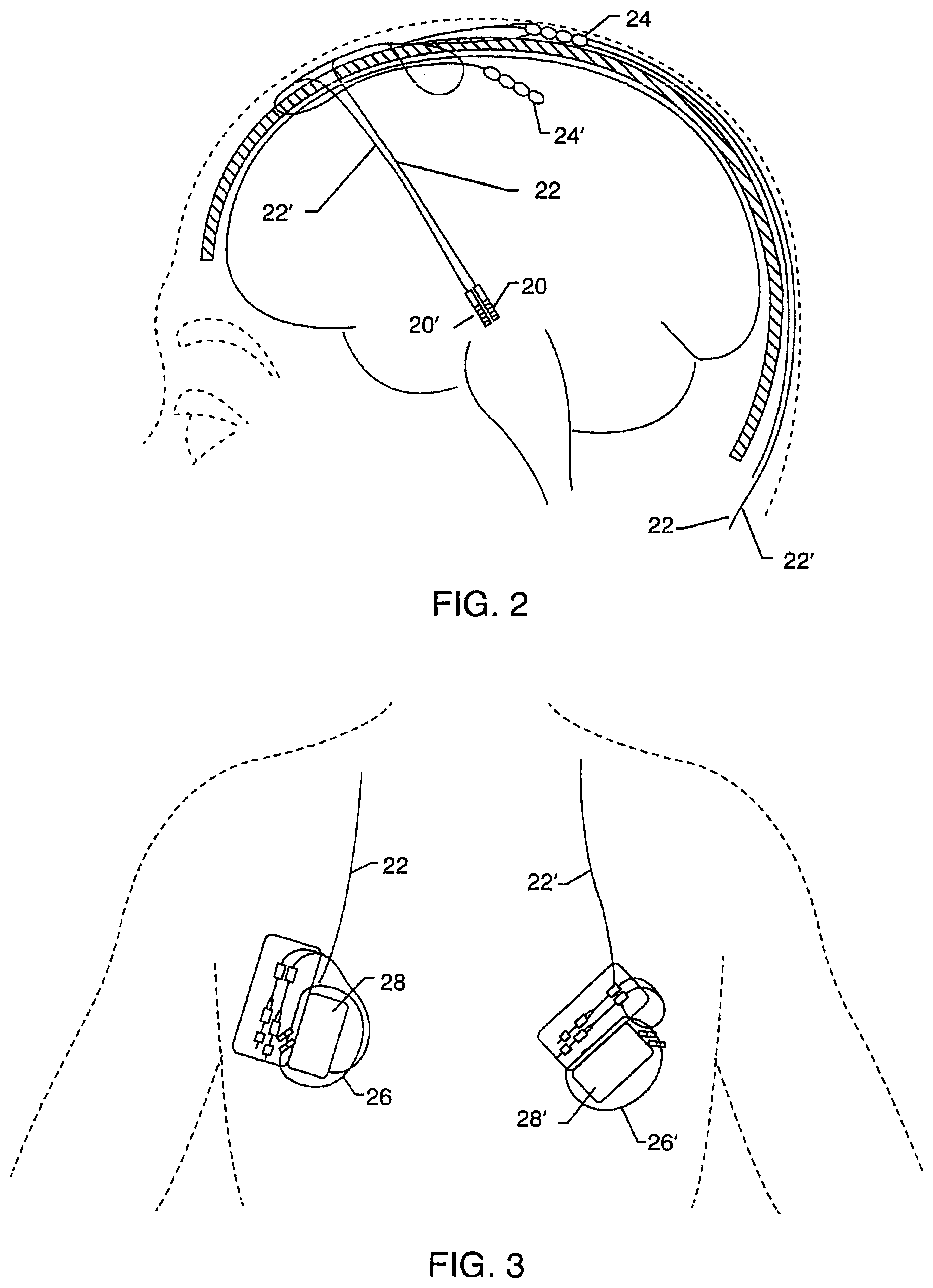 Patent US12102831 Figure 16 – Clinical static strip magnet of alternating polarities to prevent inadvertent actuation of magnet-mode in an active implantable medical device