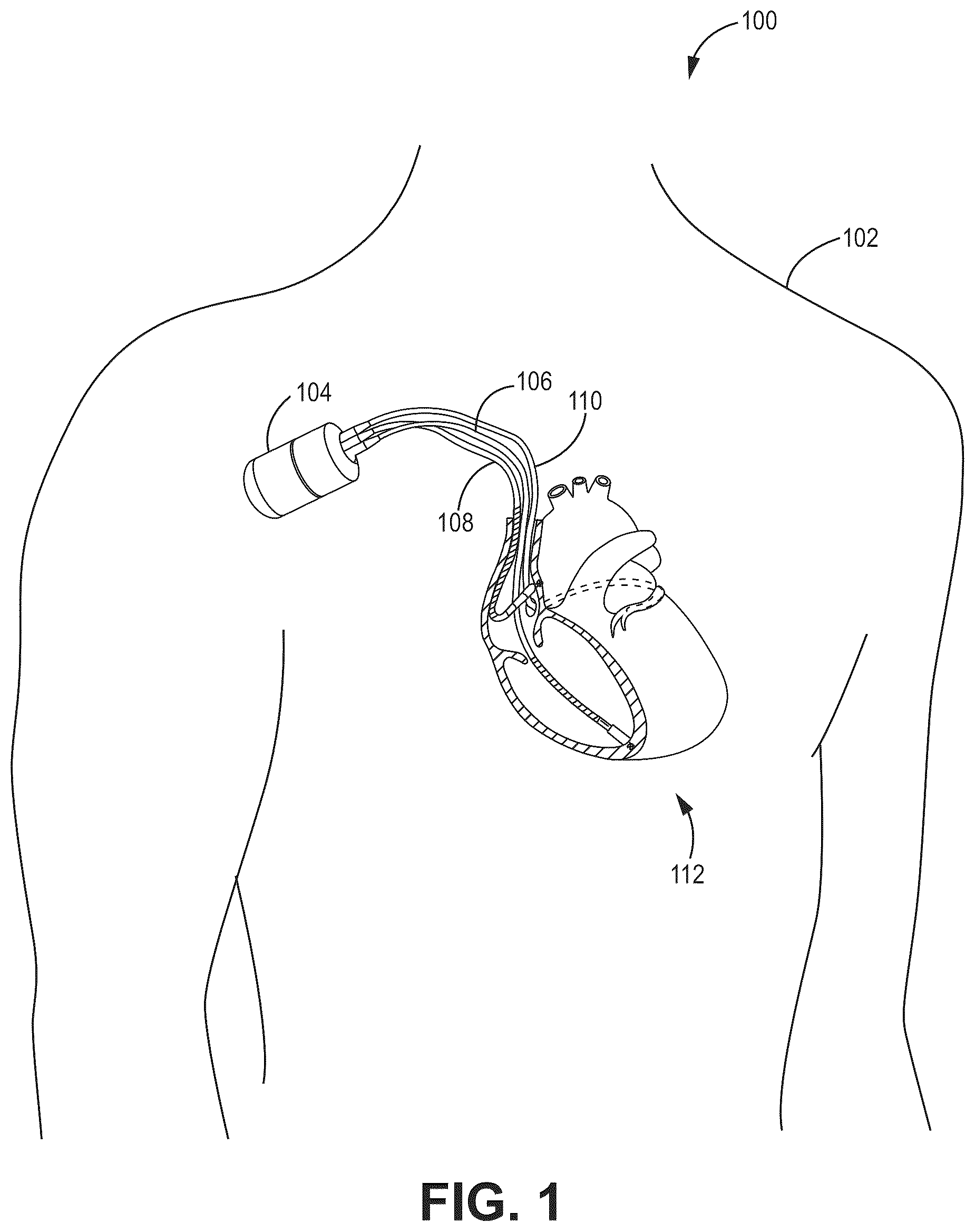 Patent US12102832 Figure 1 – Folded headspace insulator