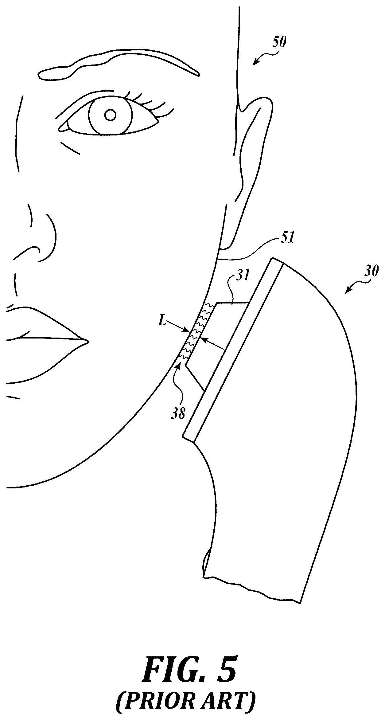 Patent US12102836 Figure 6 – Cold plasma generating array
