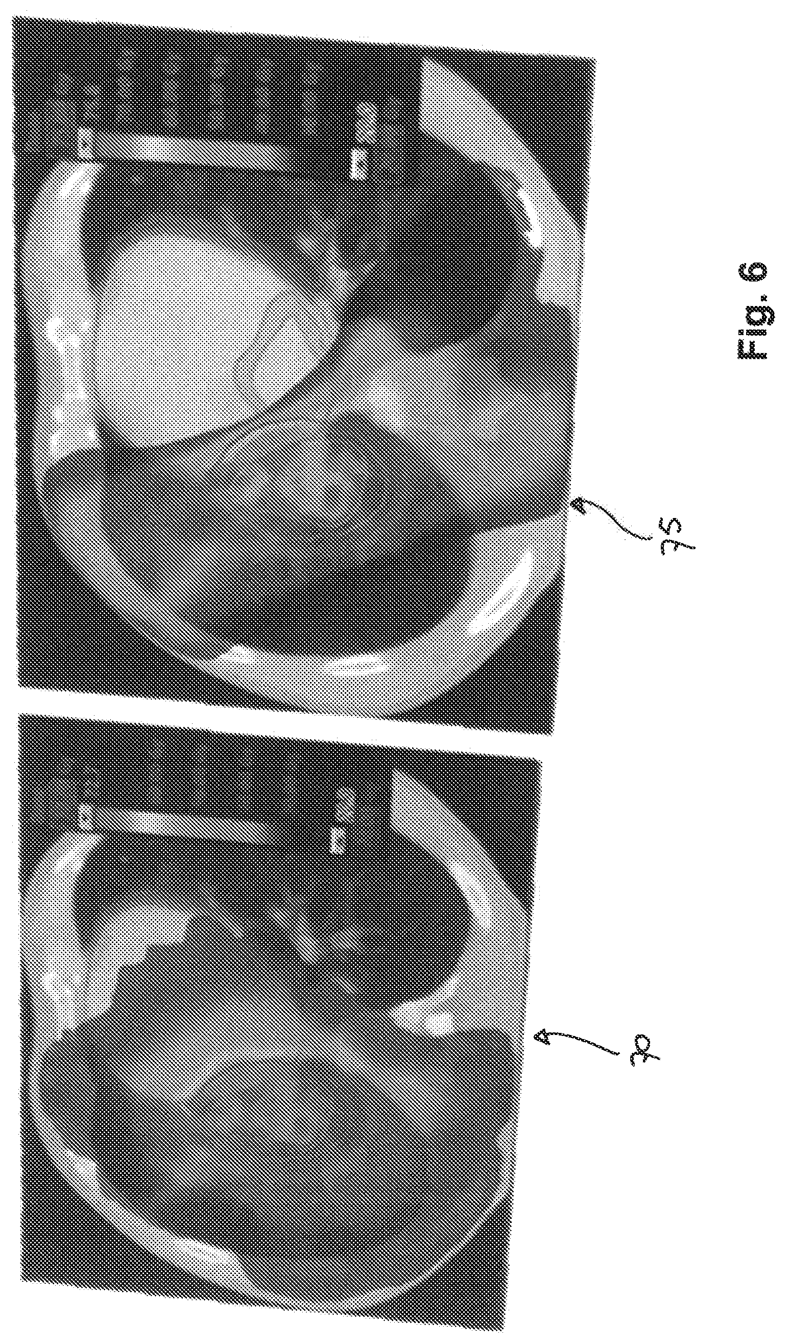 Patent US12102842 Figure 6 – Treatment and planning for lymphocytes sparing radiotherapy