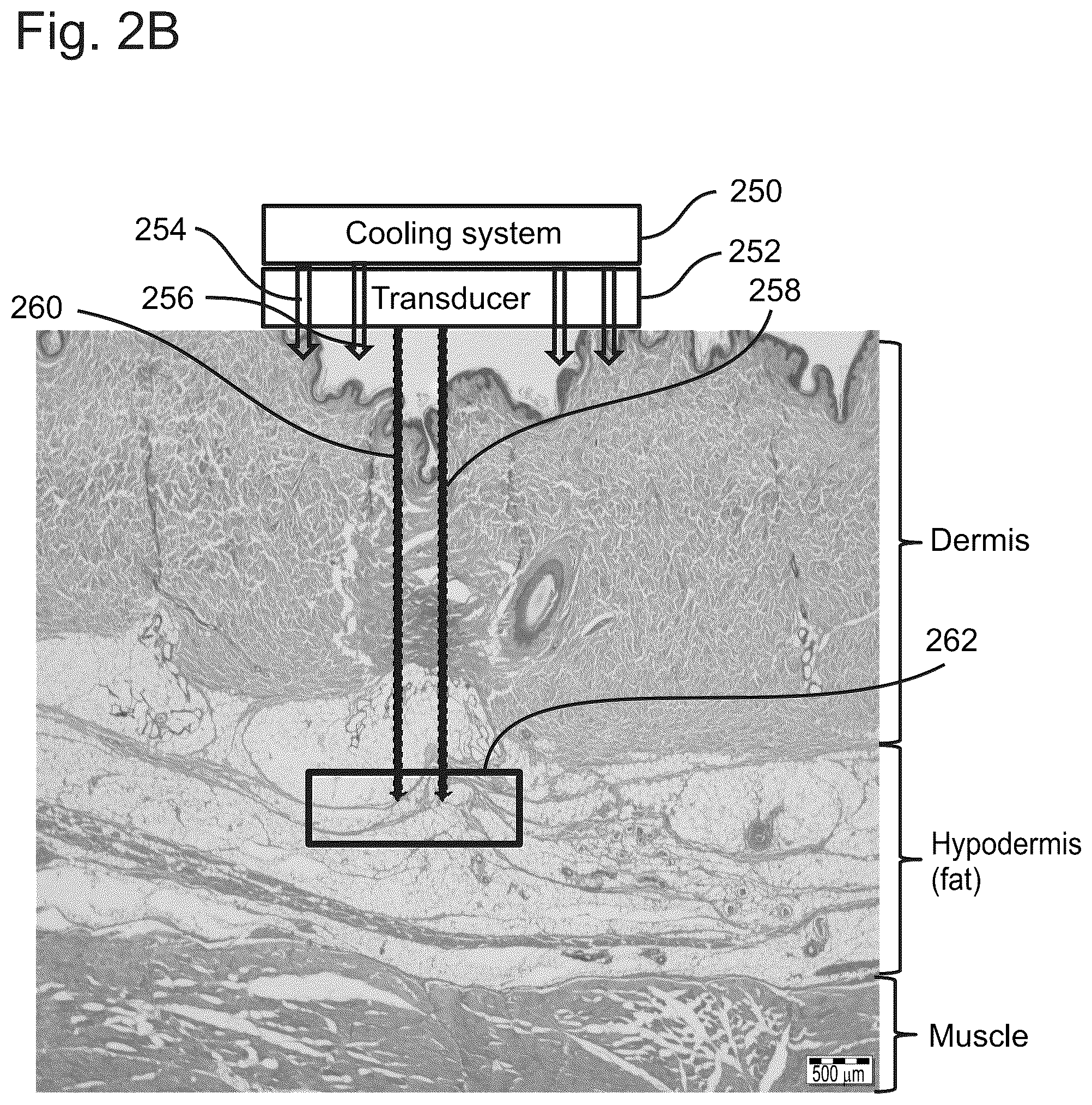 Patent US12102844 Figure 3 – Fat tissue treatment