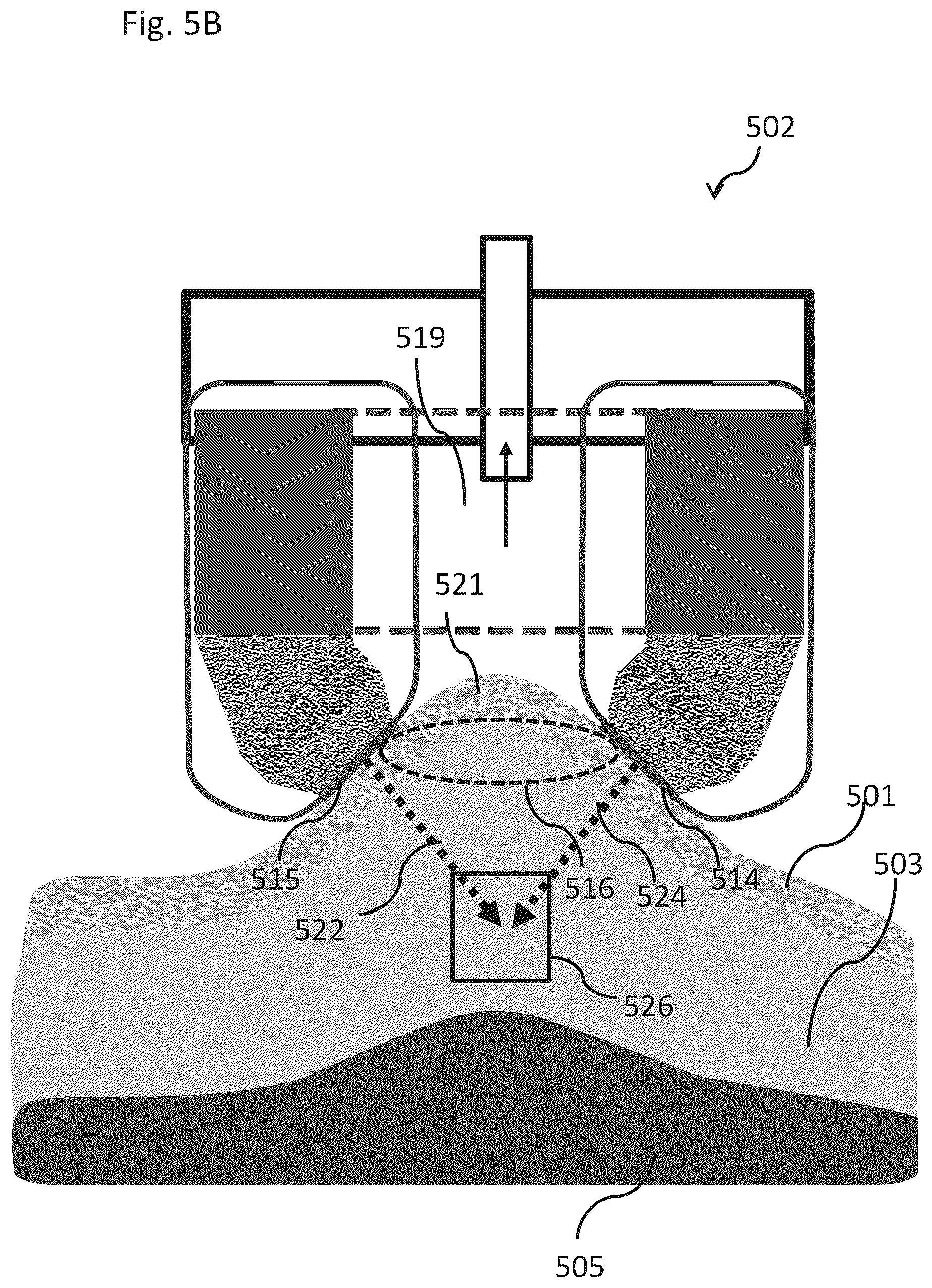 Patent US12102844 Figure 13 – Fat tissue treatment