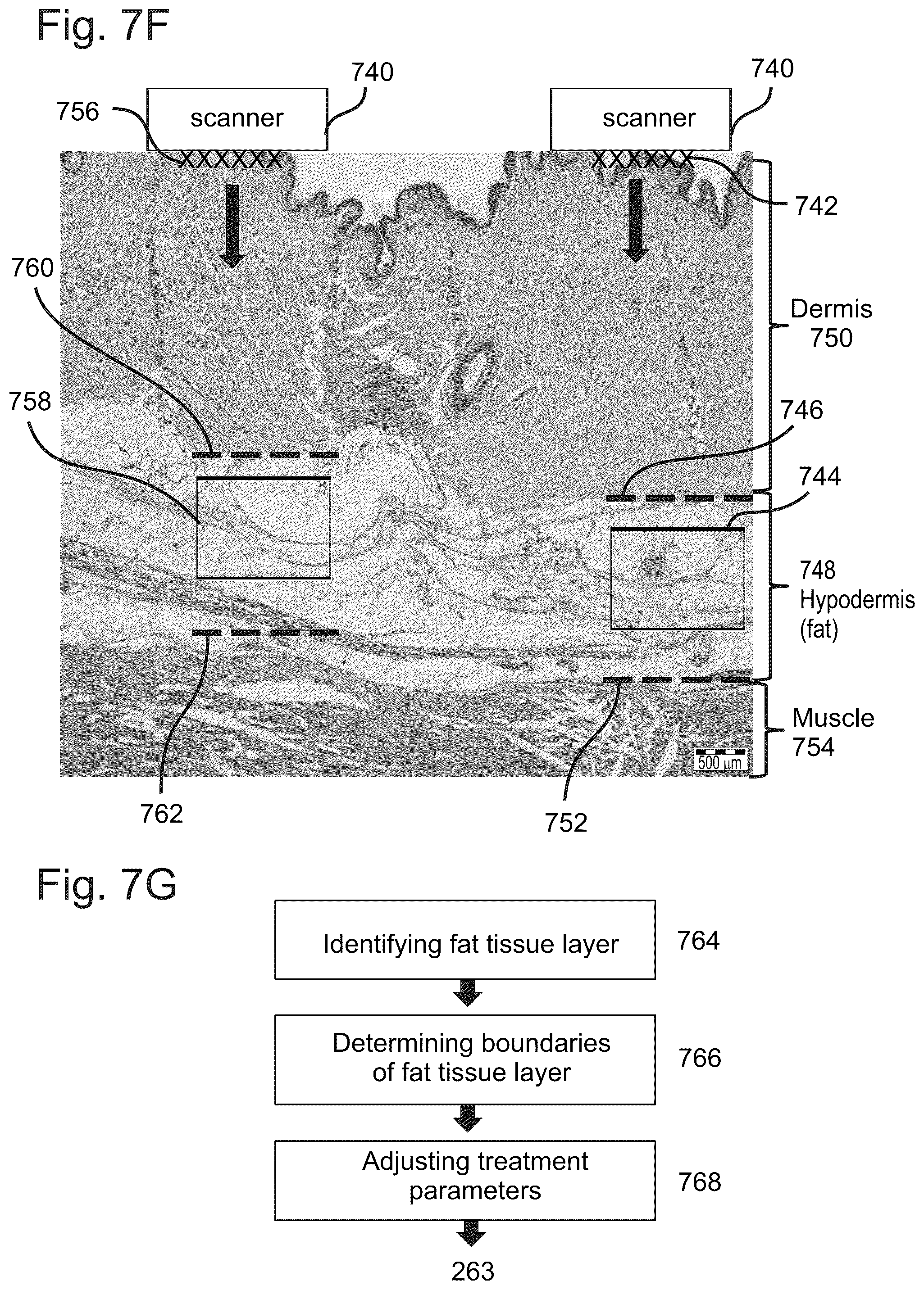 Patent US12102844 Figure 20 – Fat tissue treatment