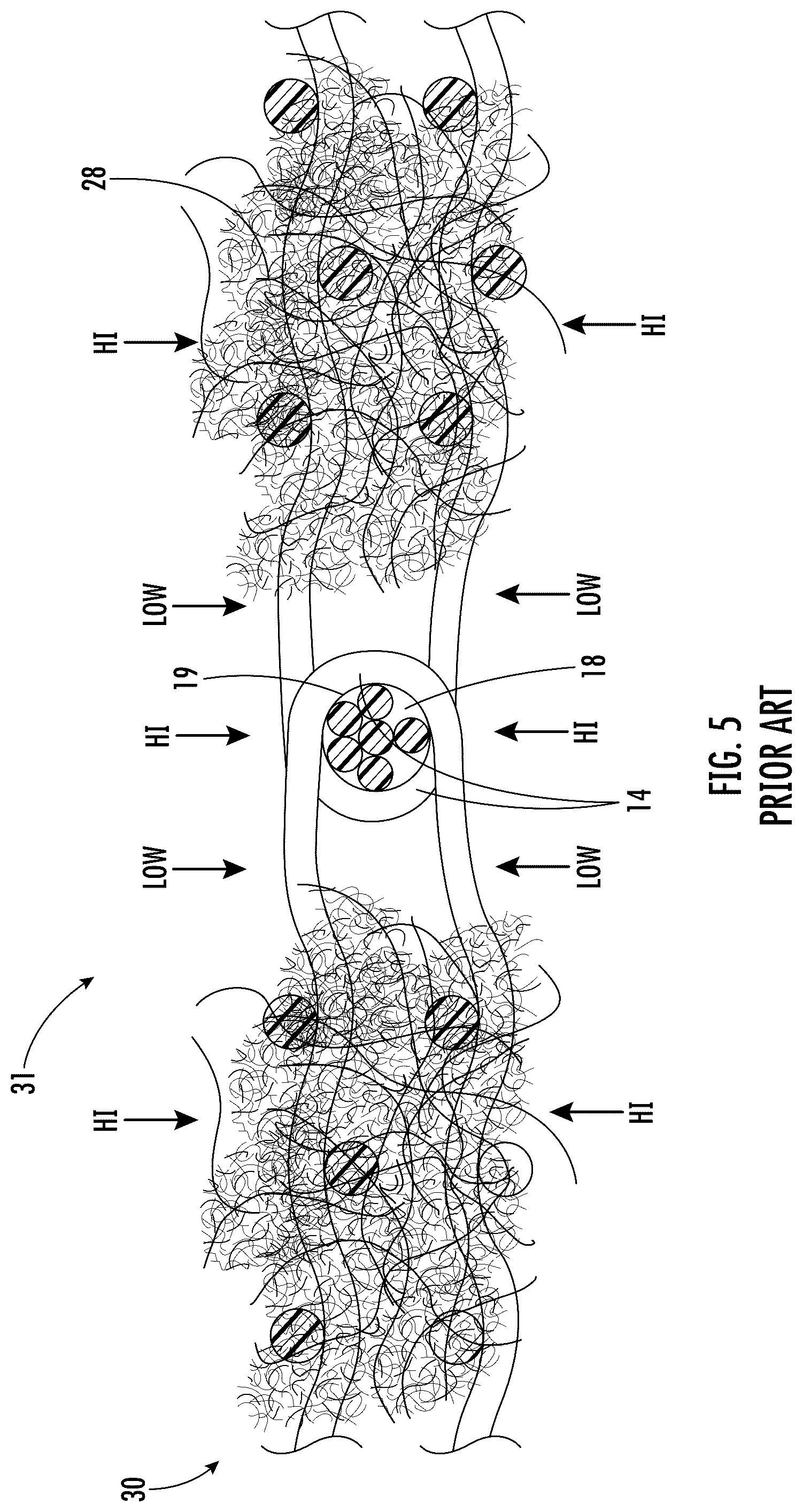 Patent US12104323 Figure 3 – Seamed press felt with partially anchored stuffer yarn packager