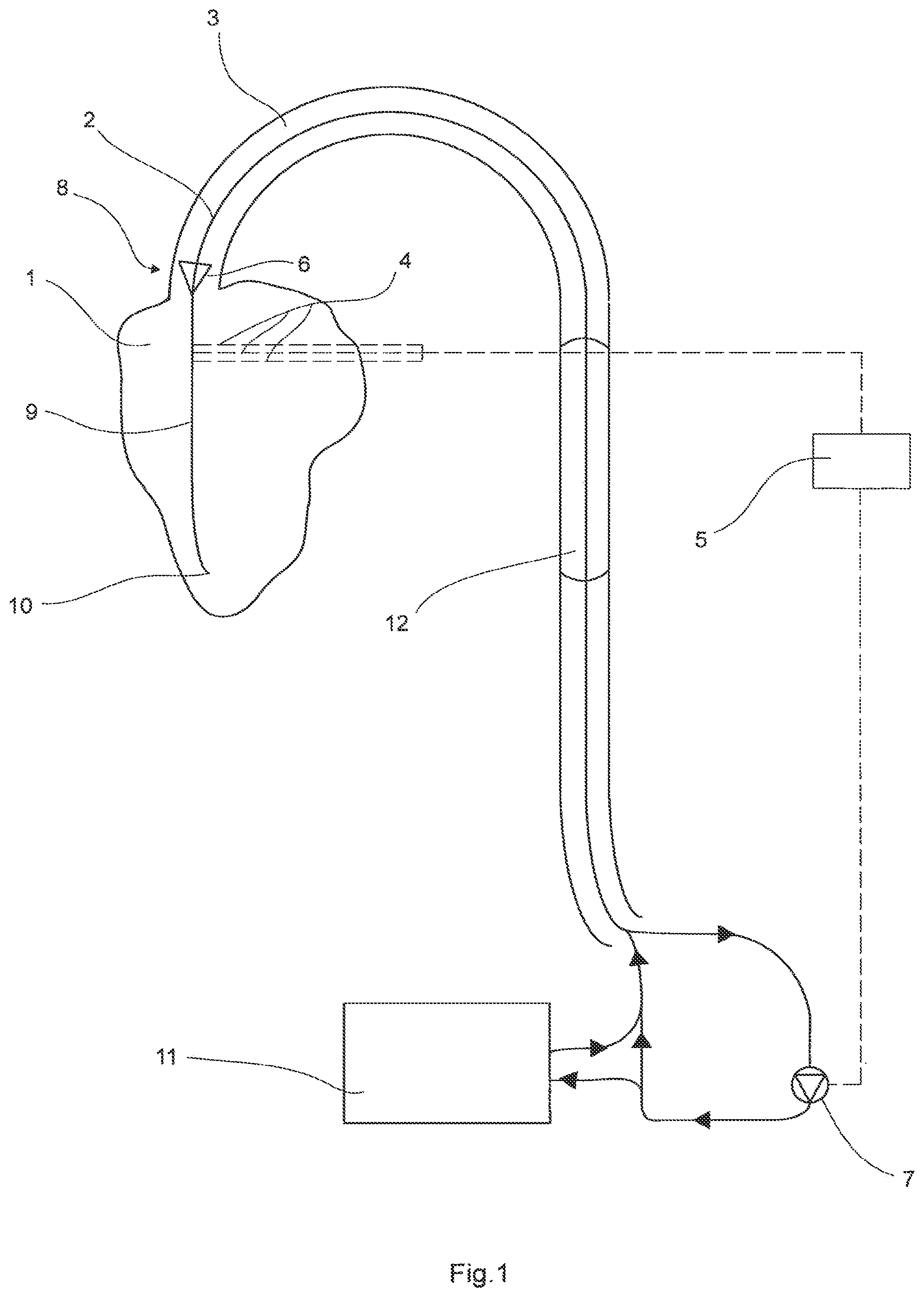 Patent US12104600 Figure 1 – Device to assist the performance of a heart