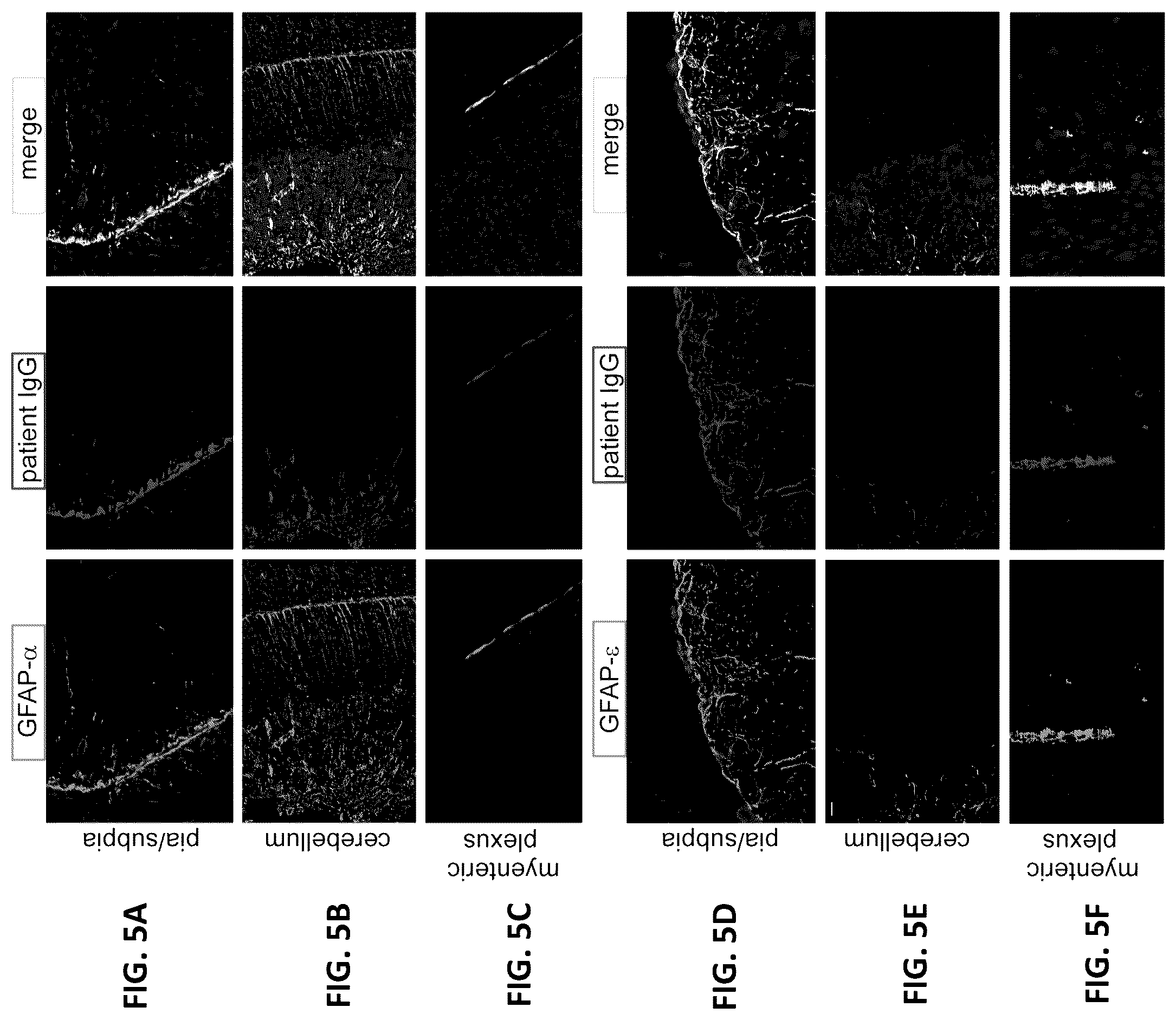 Patent US12105088 Figure 5 – Methods and materials for identifying and treating autoimmune GFAP astrocytopathy