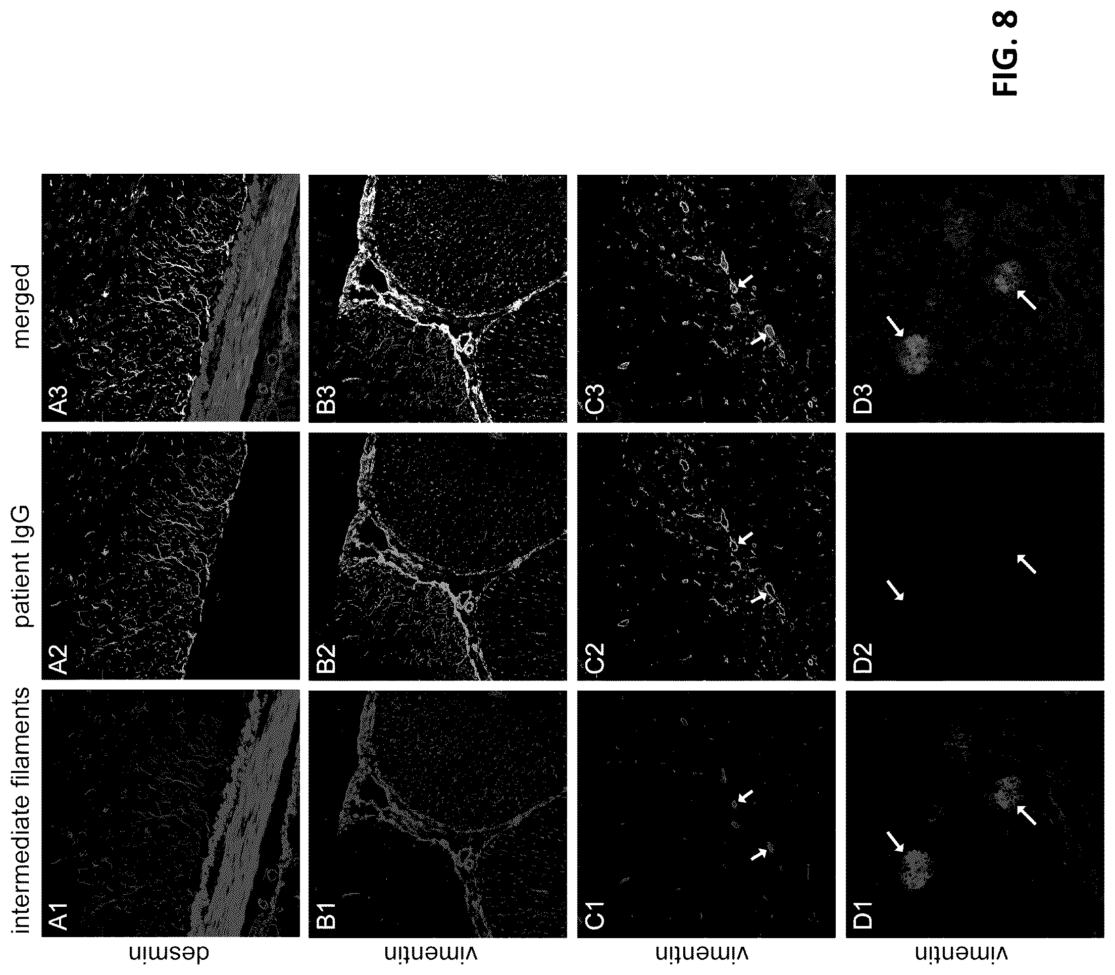 Patent US12105088 Figure 8 – Methods and materials for identifying and treating autoimmune GFAP astrocytopathy