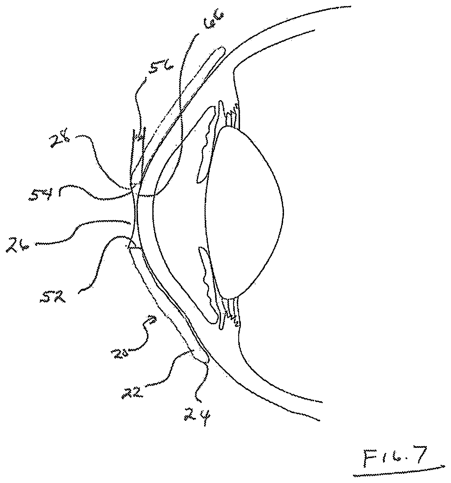 Patent US12105359 Figure 3 – Tear shaping for refractive correction