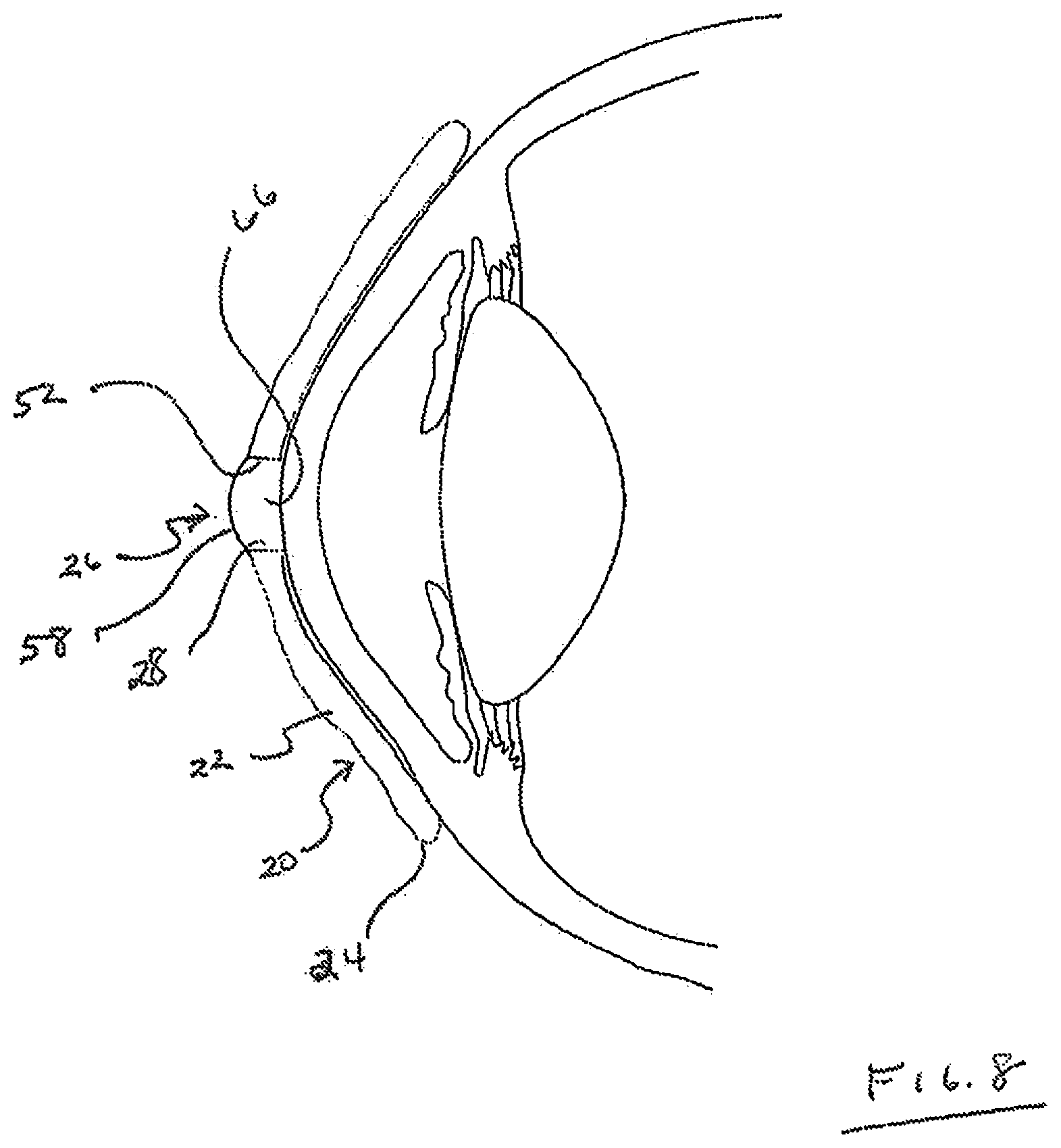 Patent US12105359 Figure 4 – Tear shaping for refractive correction