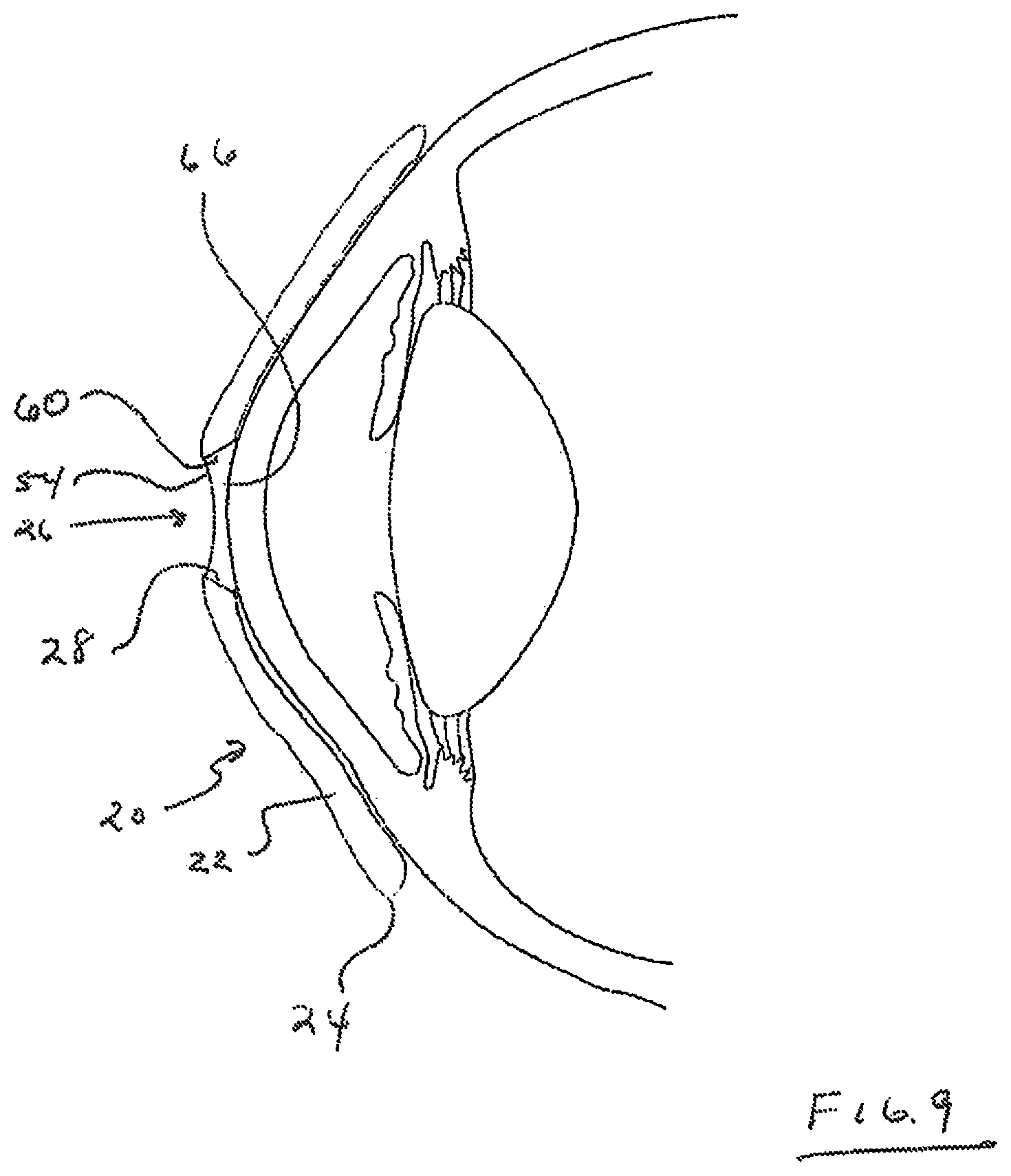 Patent US12105359 Figure 5 – Tear shaping for refractive correction