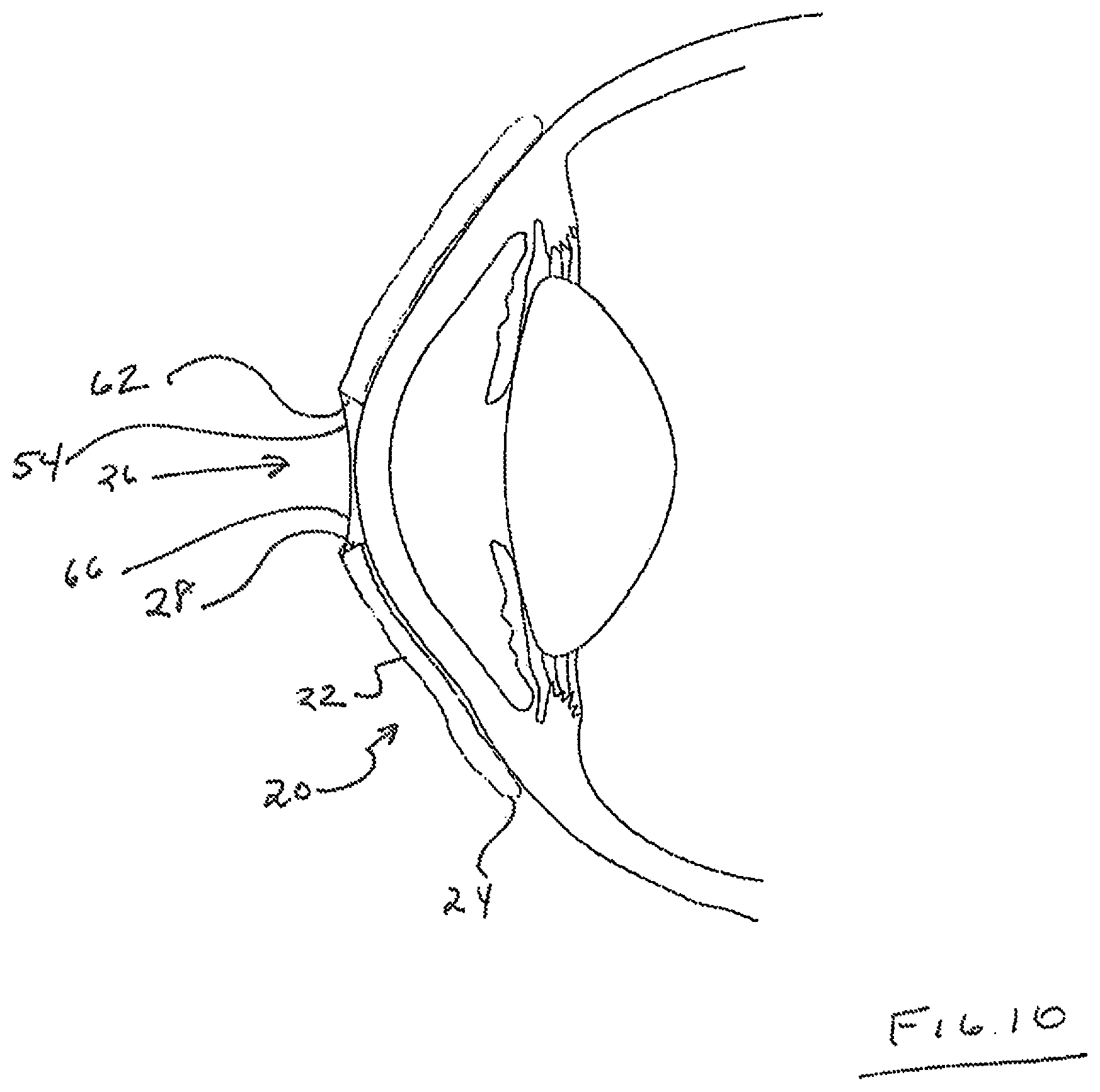 Patent US12105359 Figure 6 – Tear shaping for refractive correction